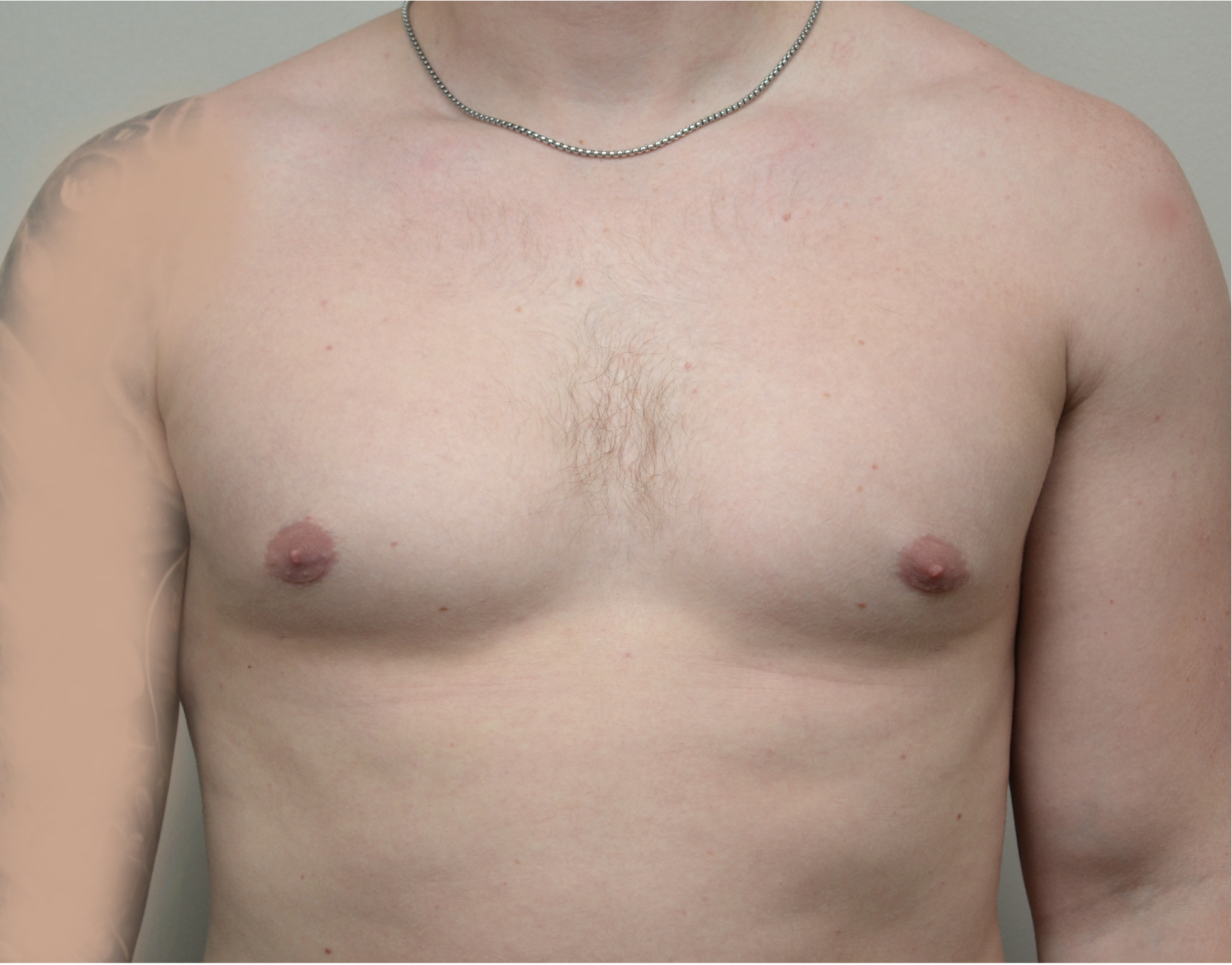 Gynecomastia Before & After Case 6