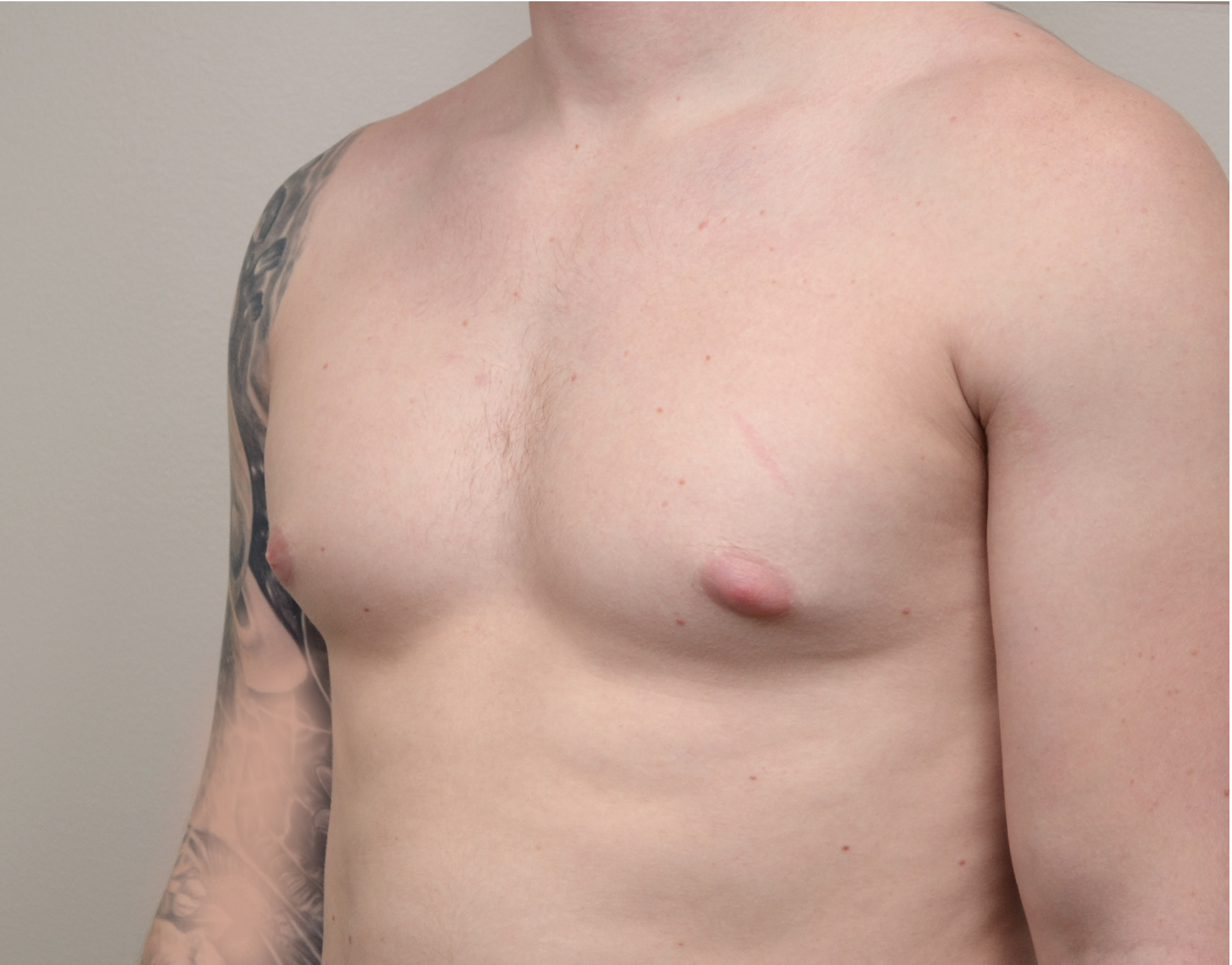Gynecomastia Before & After Case 6