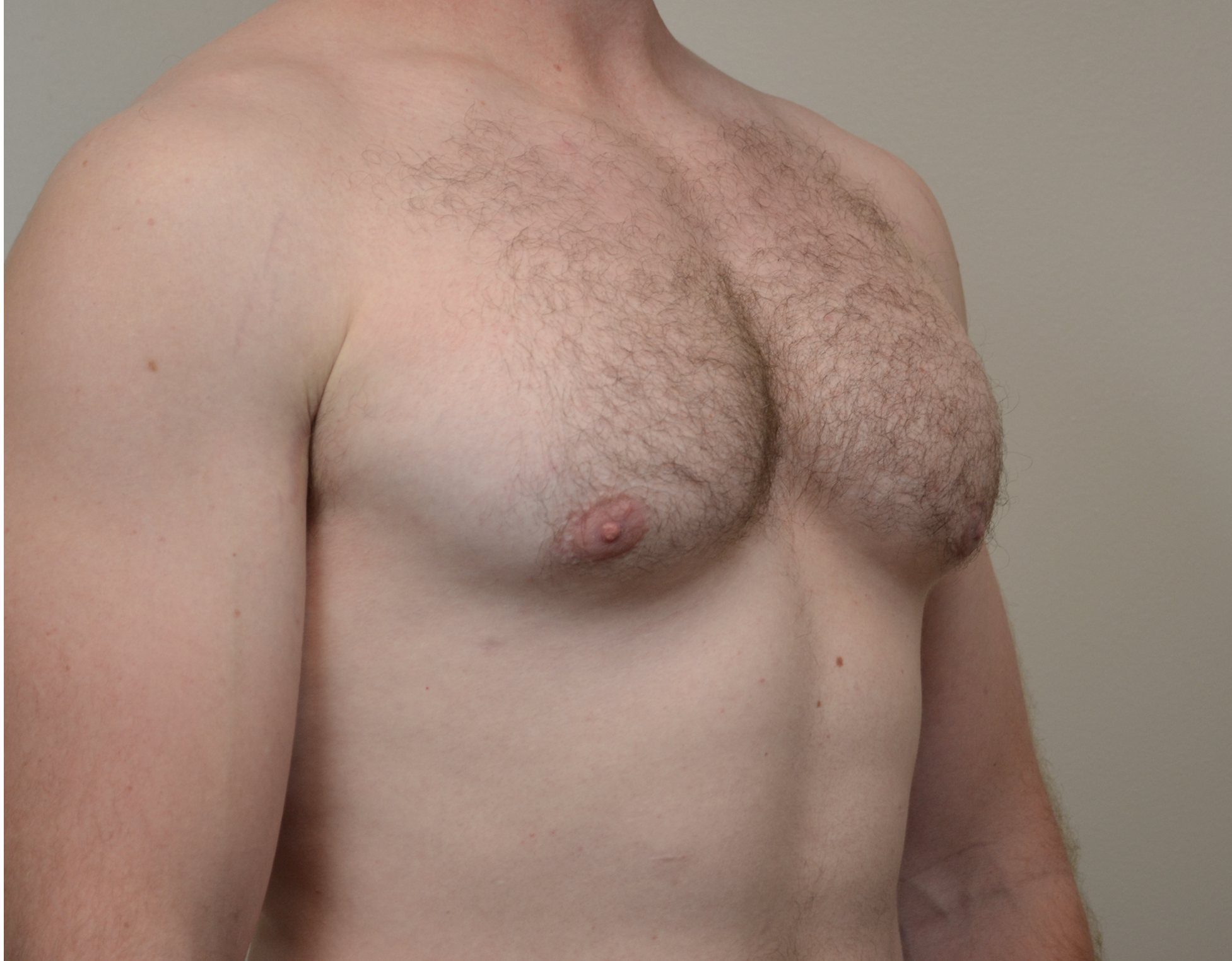 Gynecomastia Before & After Case 1