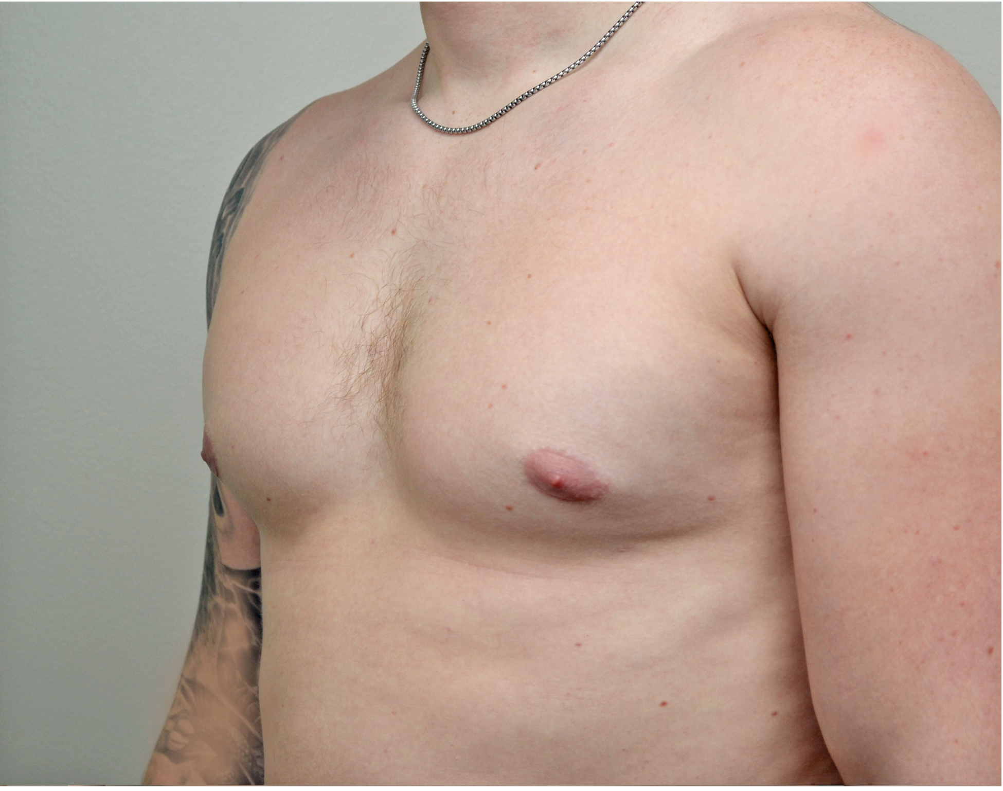 Gynecomastia Before & After Case 6