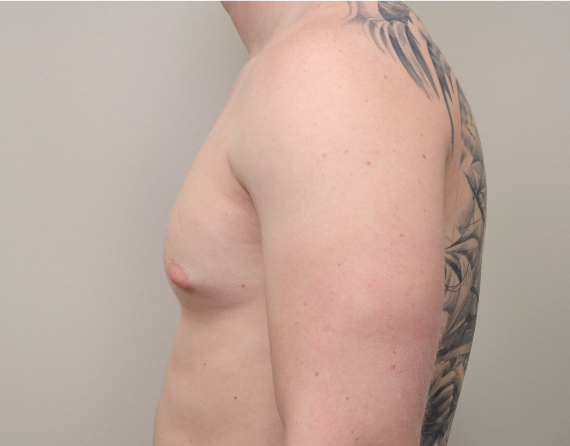 Gynecomastia Before & After Case 6