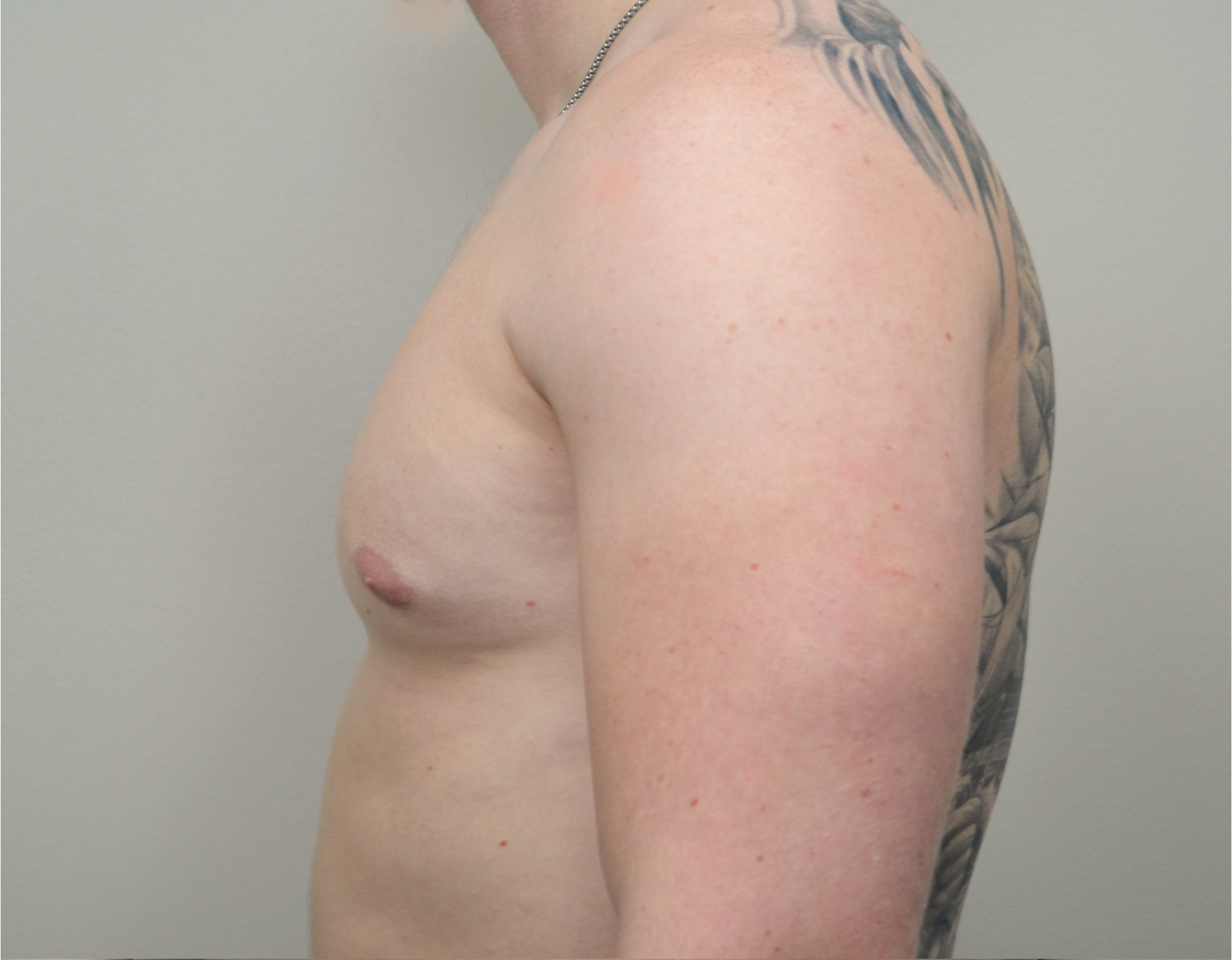 Gynecomastia Before & After Case 6
