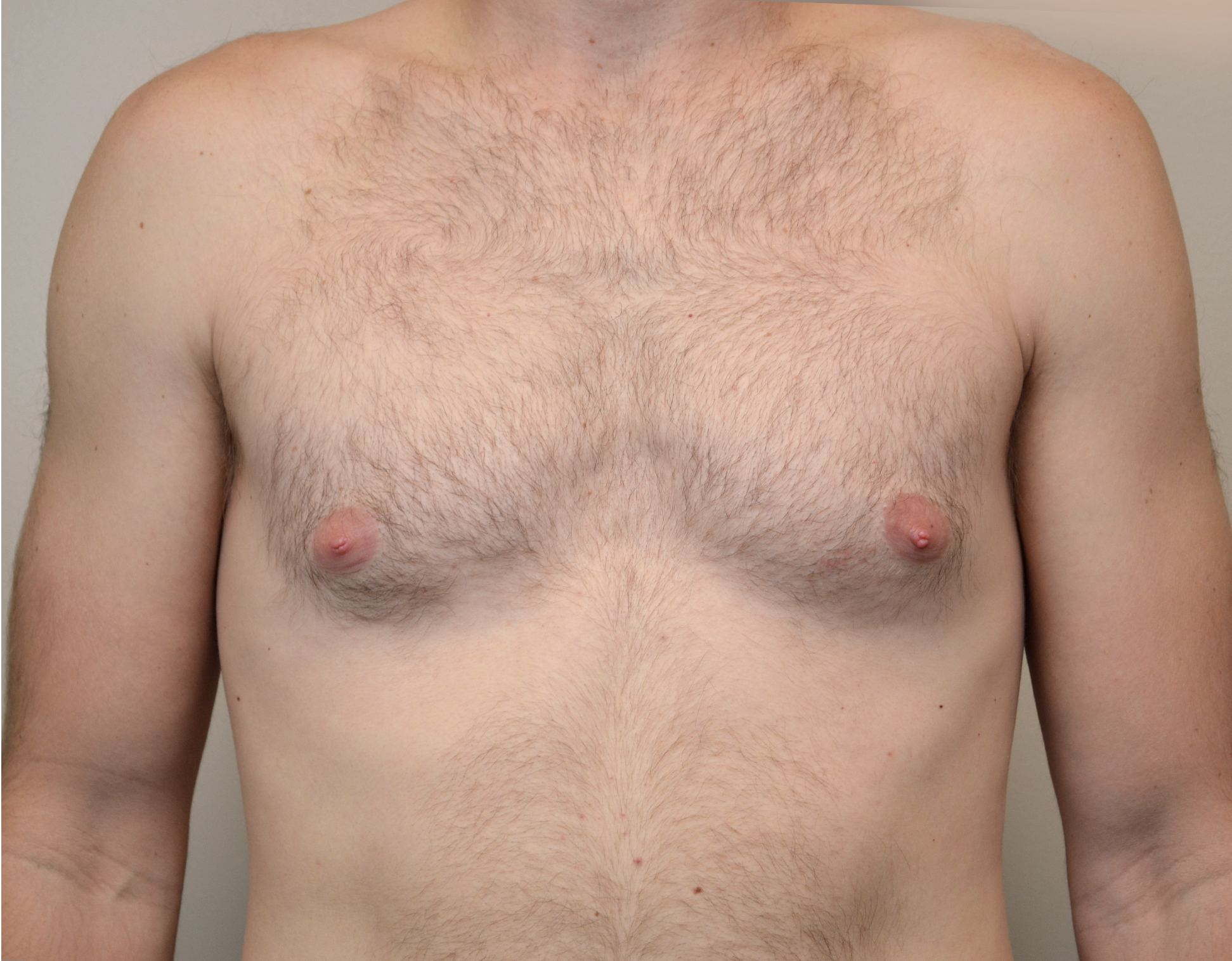 Gynecomastia Before & After Case 7