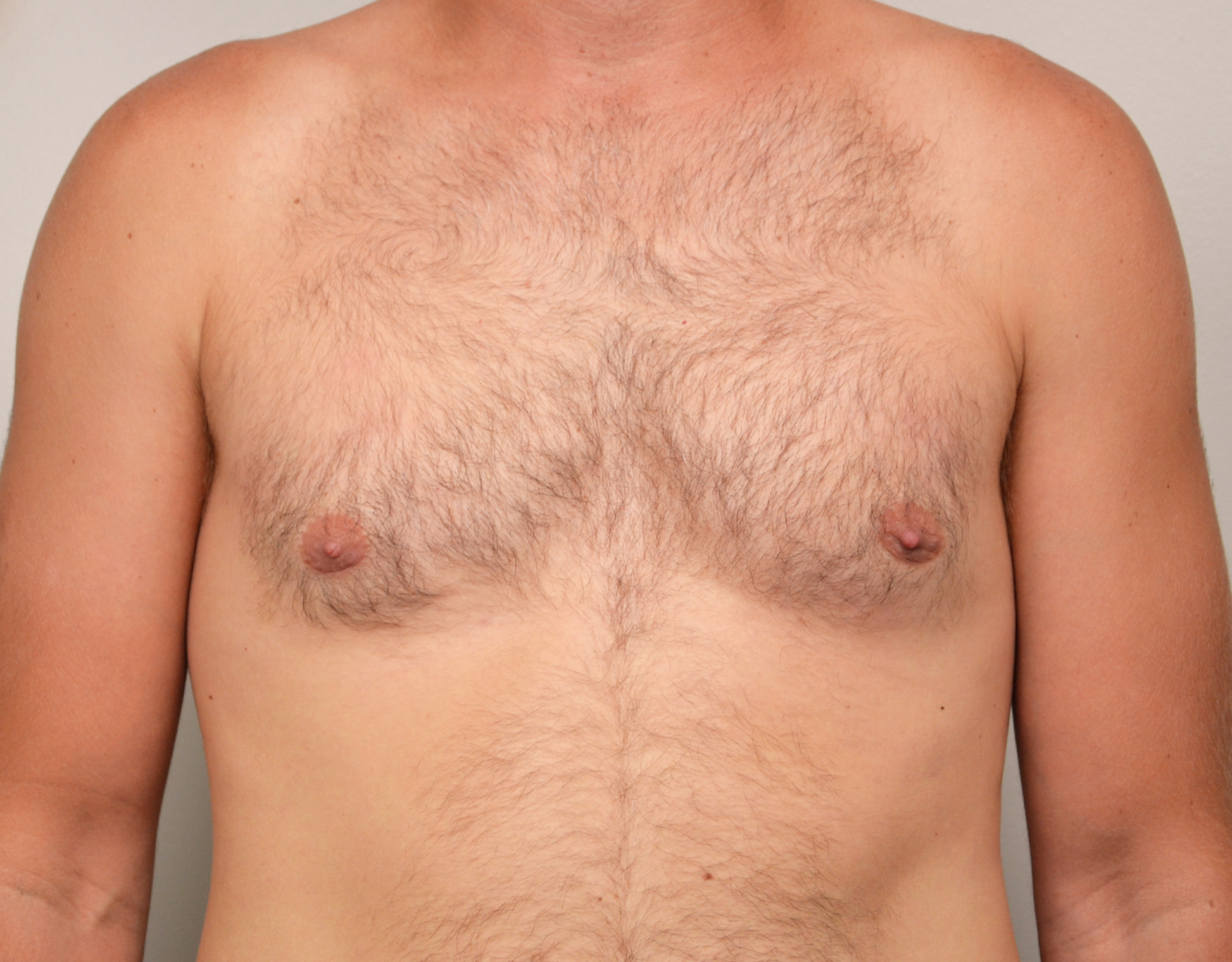 Gynecomastia Before & After Case 7