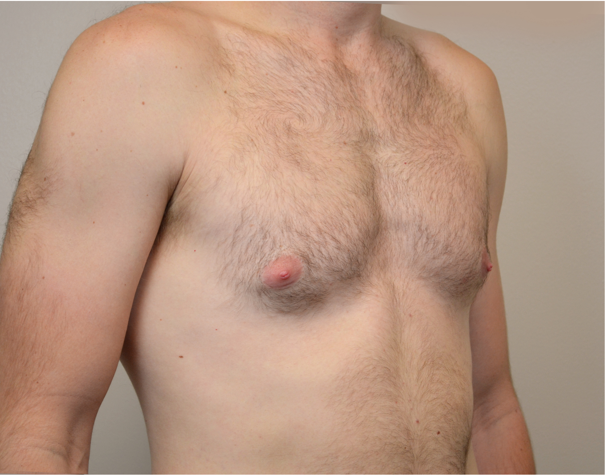 Gynecomastia Before & After Case 7