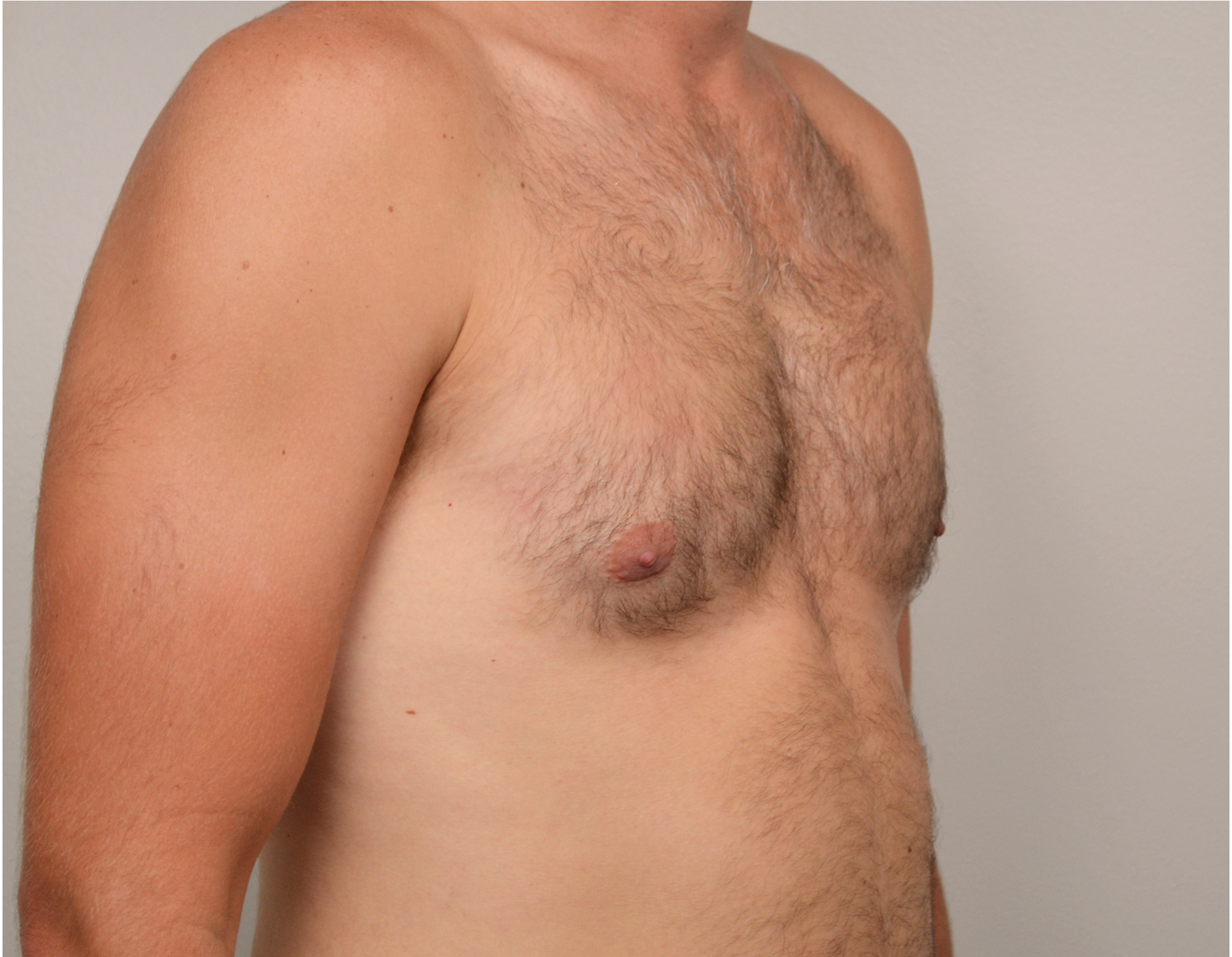 Gynecomastia Before & After Case 7