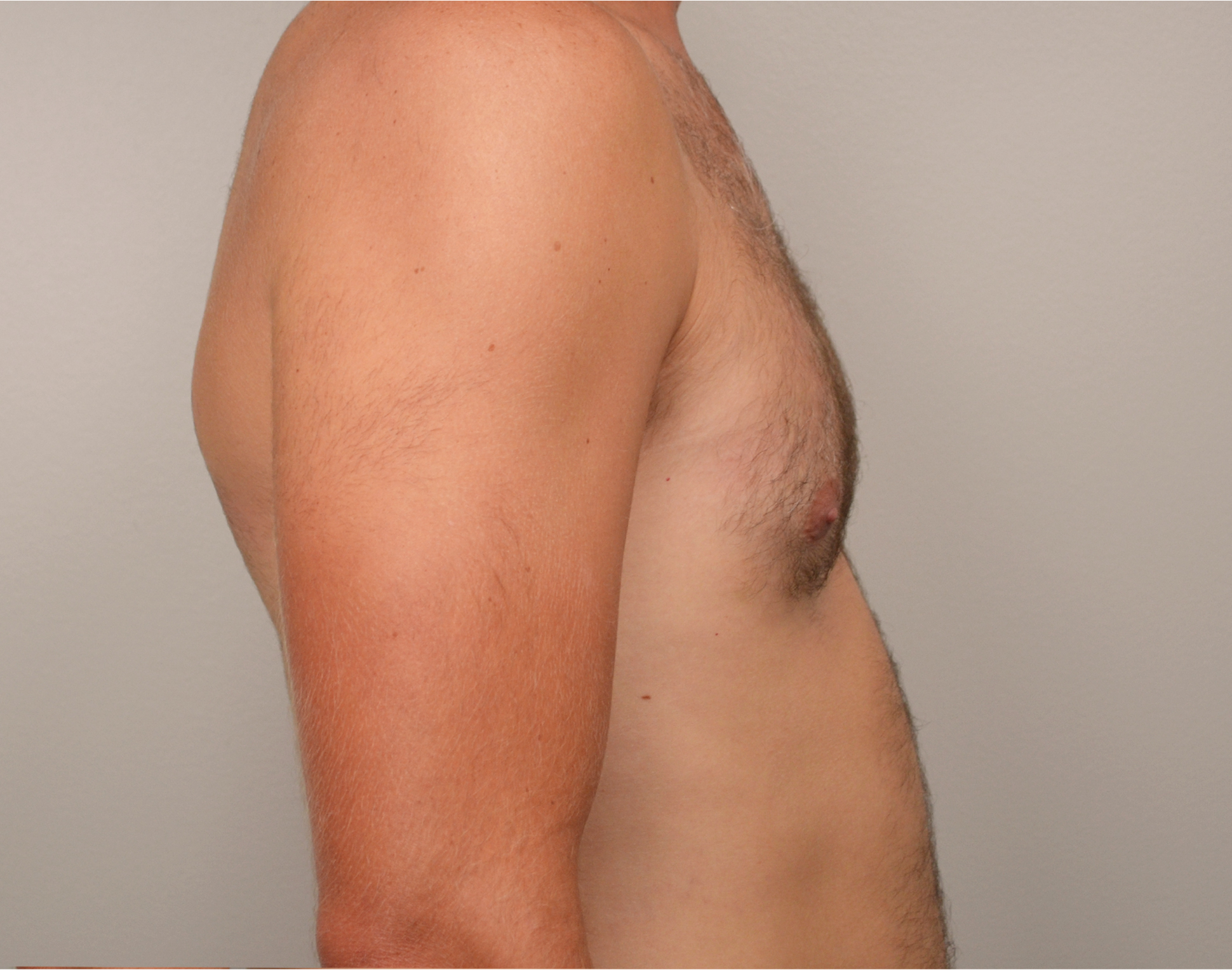 Gynecomastia Before & After Case 7