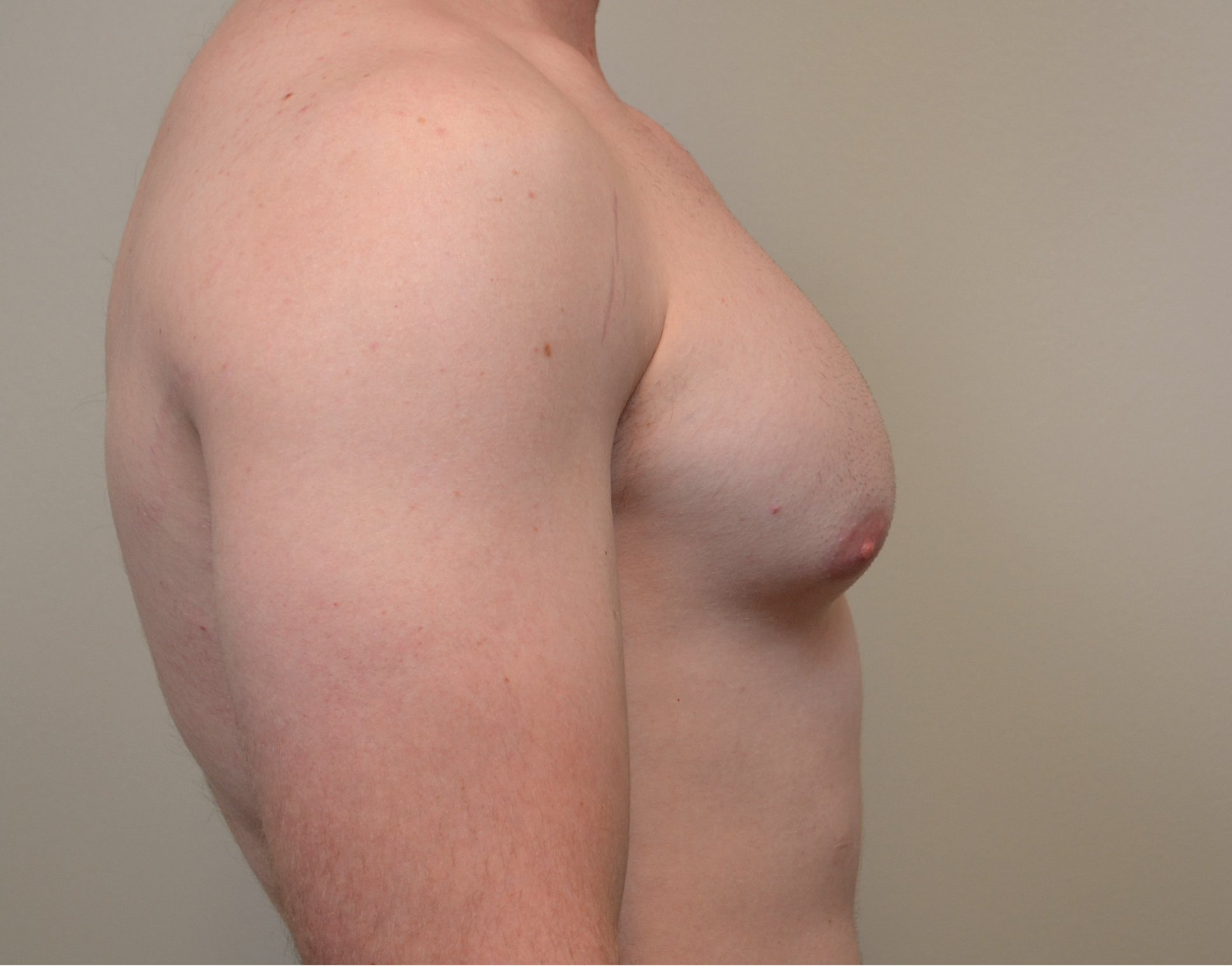 Gynecomastia Before & After Case 1