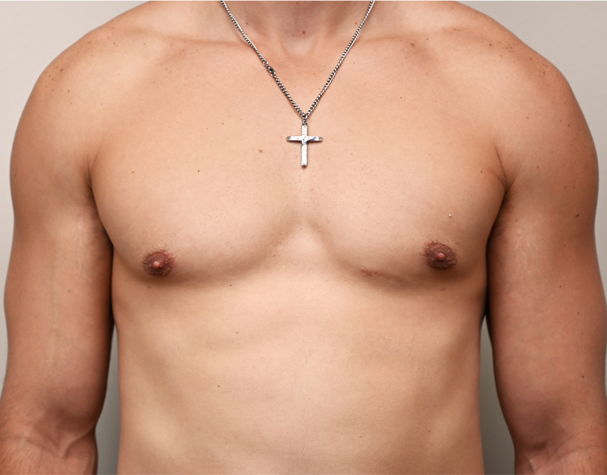 Gynecomastia Before & After Case 8