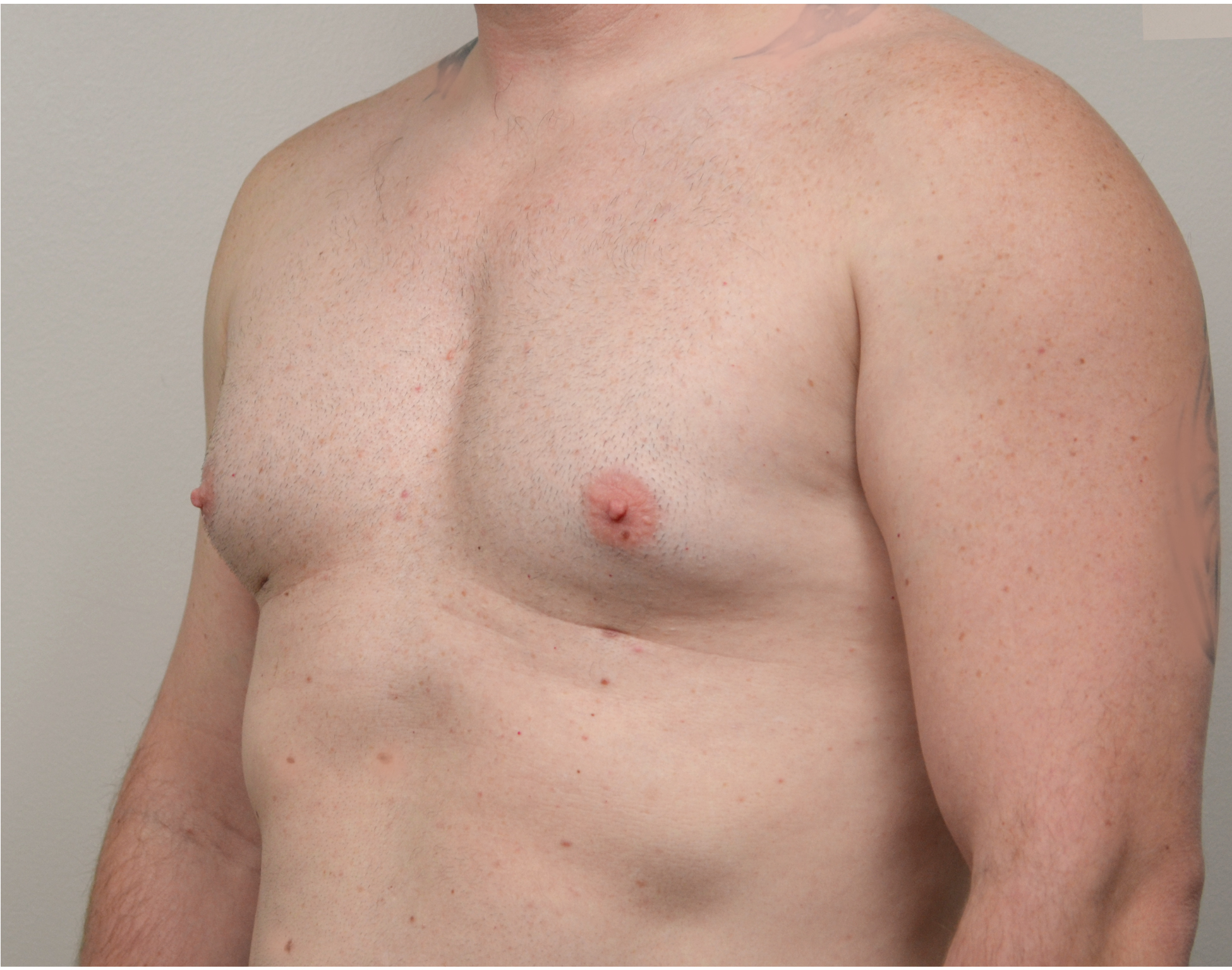 Gynecomastia Before & After Case 9