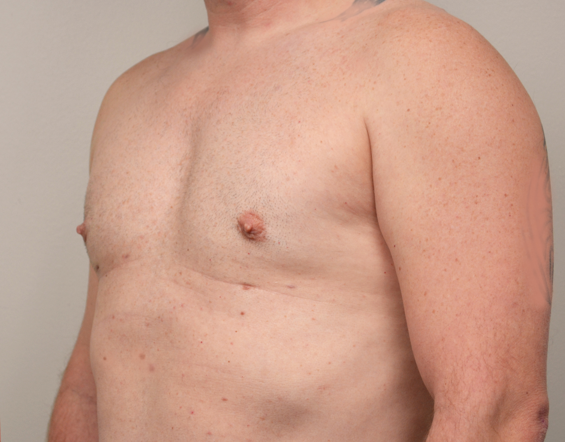 Gynecomastia Before & After Case 9