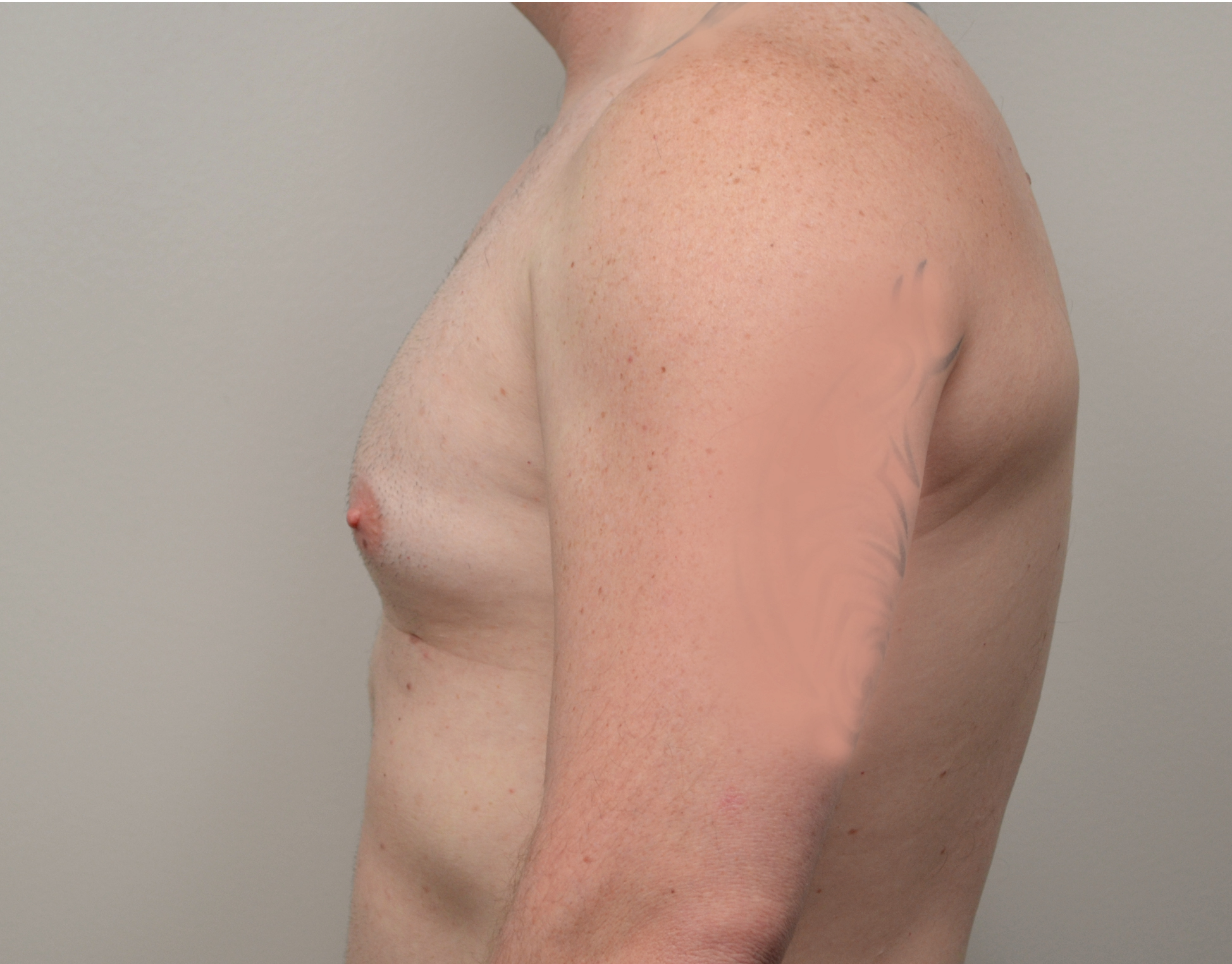 Gynecomastia Before & After Case 9