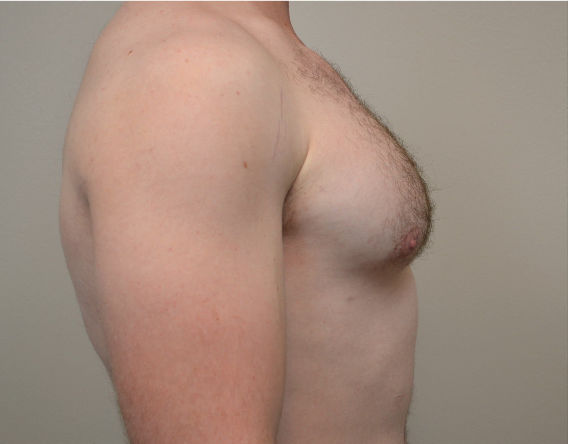 Gynecomastia Before & After Case 1