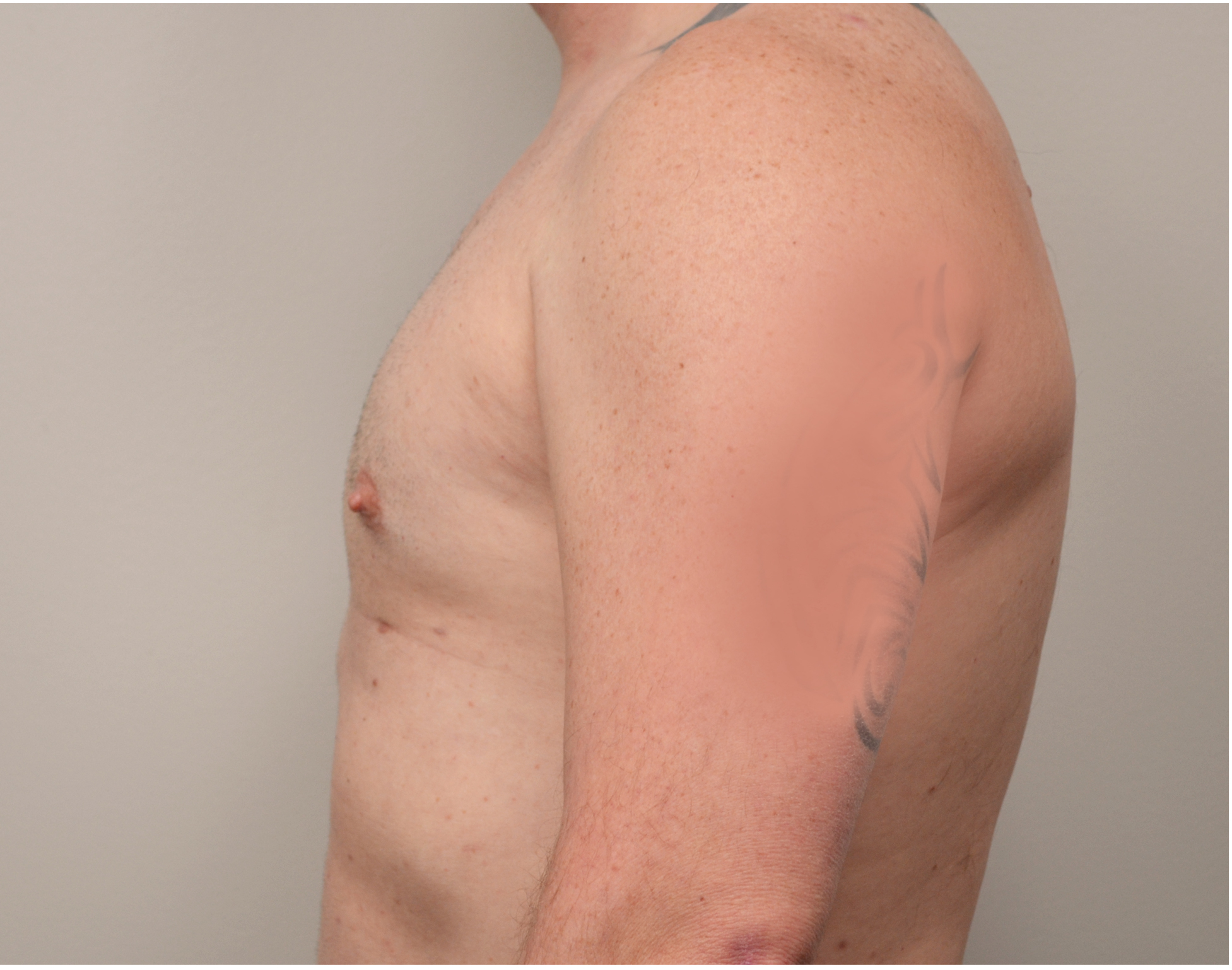 Gynecomastia Before & After Case 9