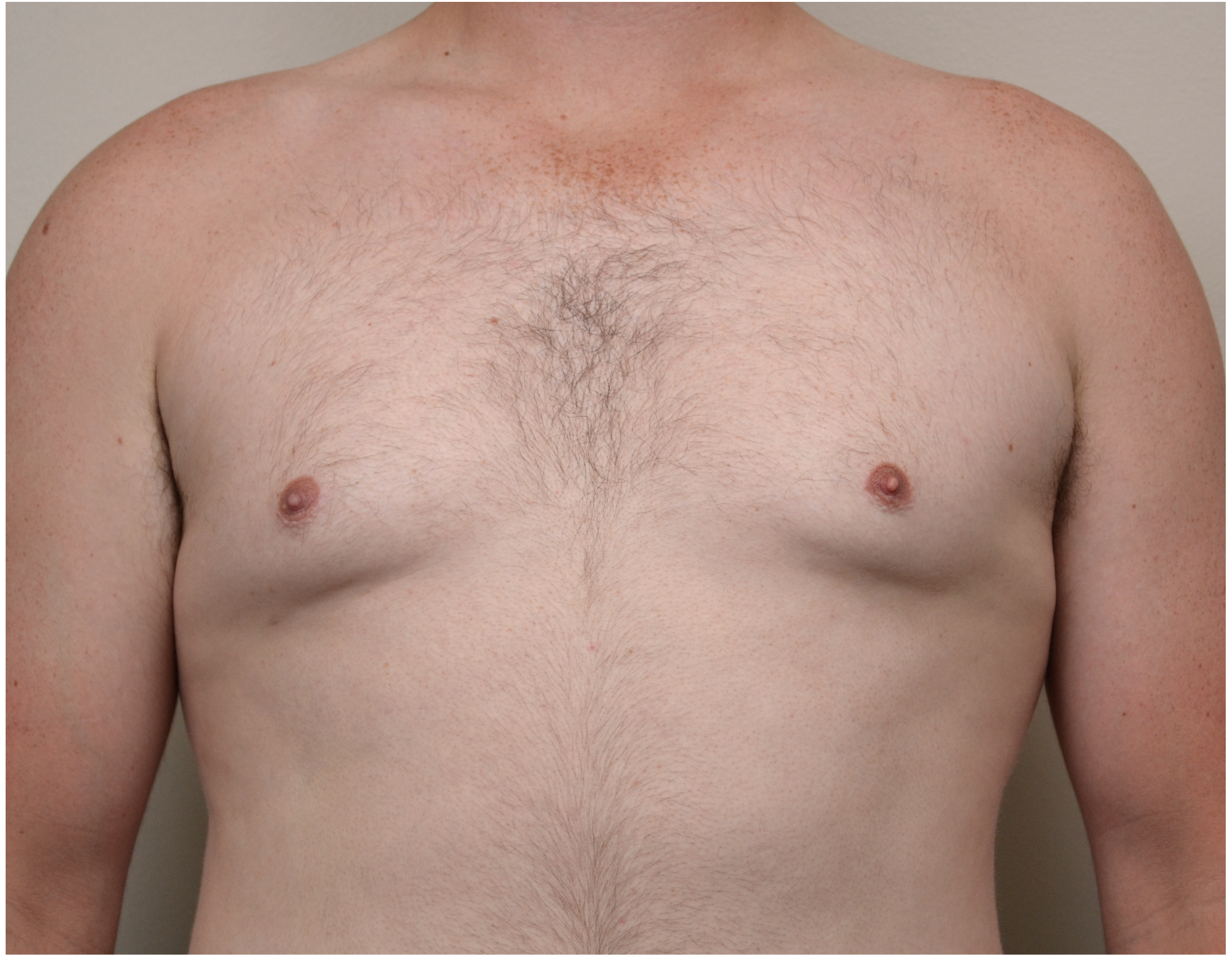 Gynecomastia Before & After Case 10