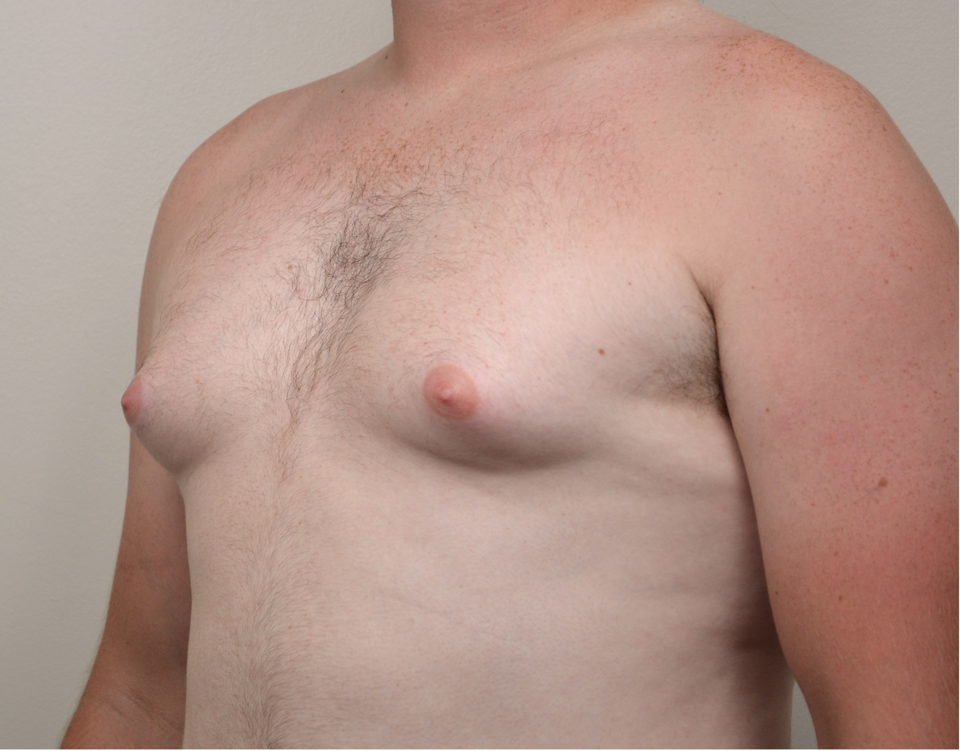Gynecomastia Before & After Case 10