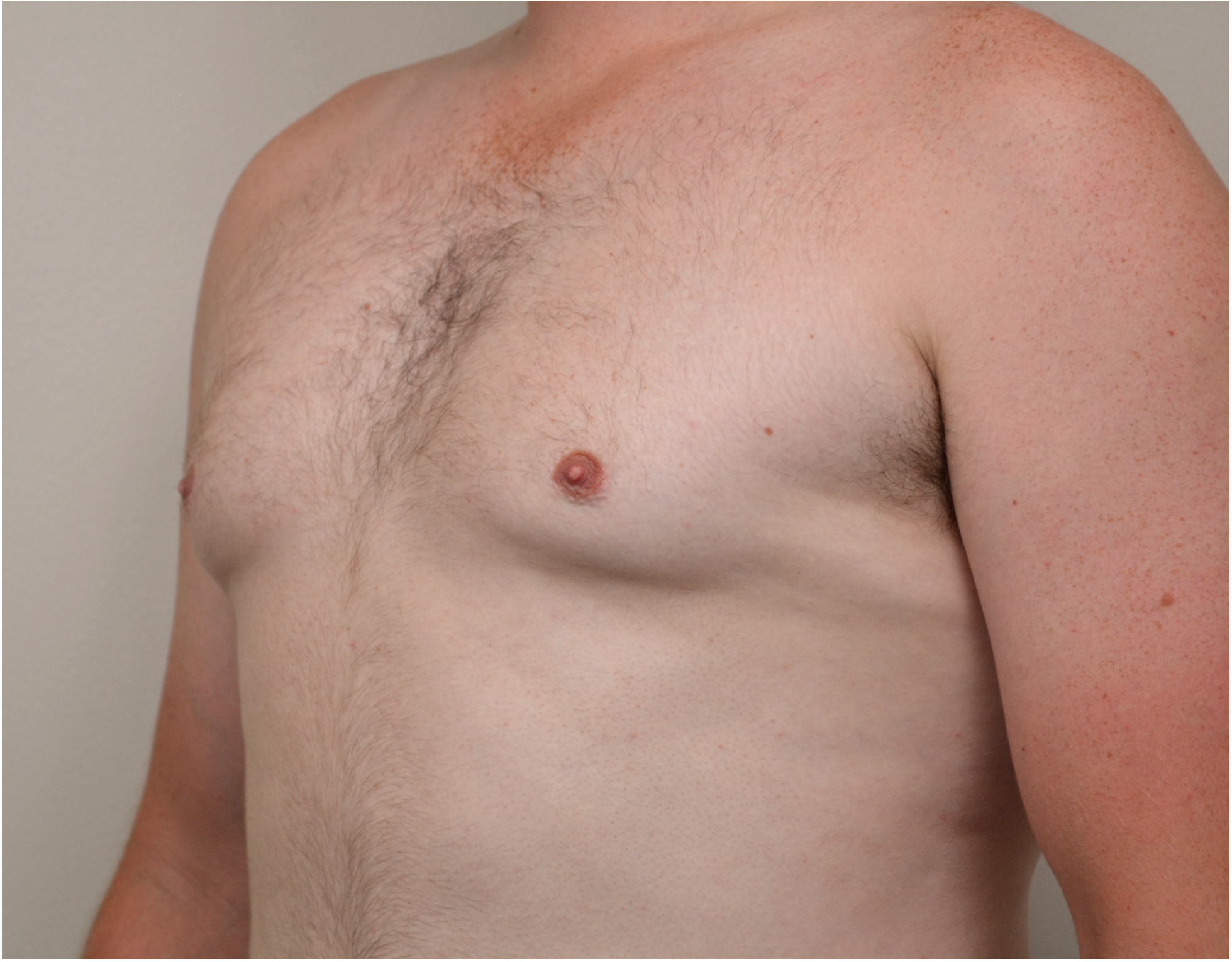Gynecomastia Before & After Case 10