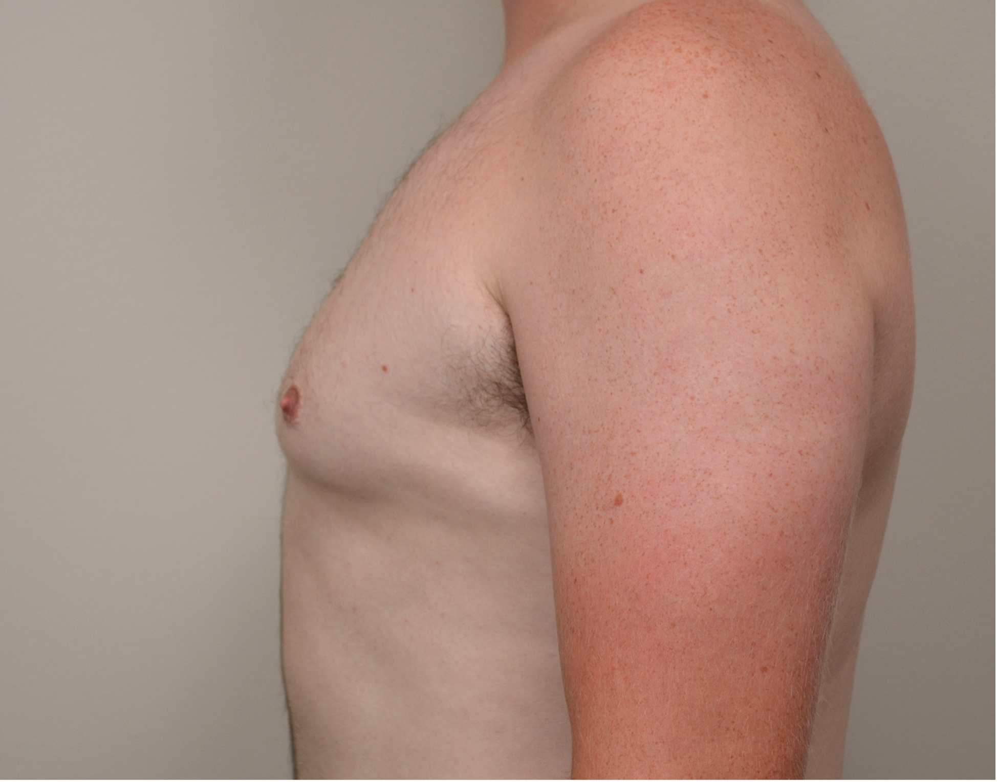 Gynecomastia Before & After Case 10