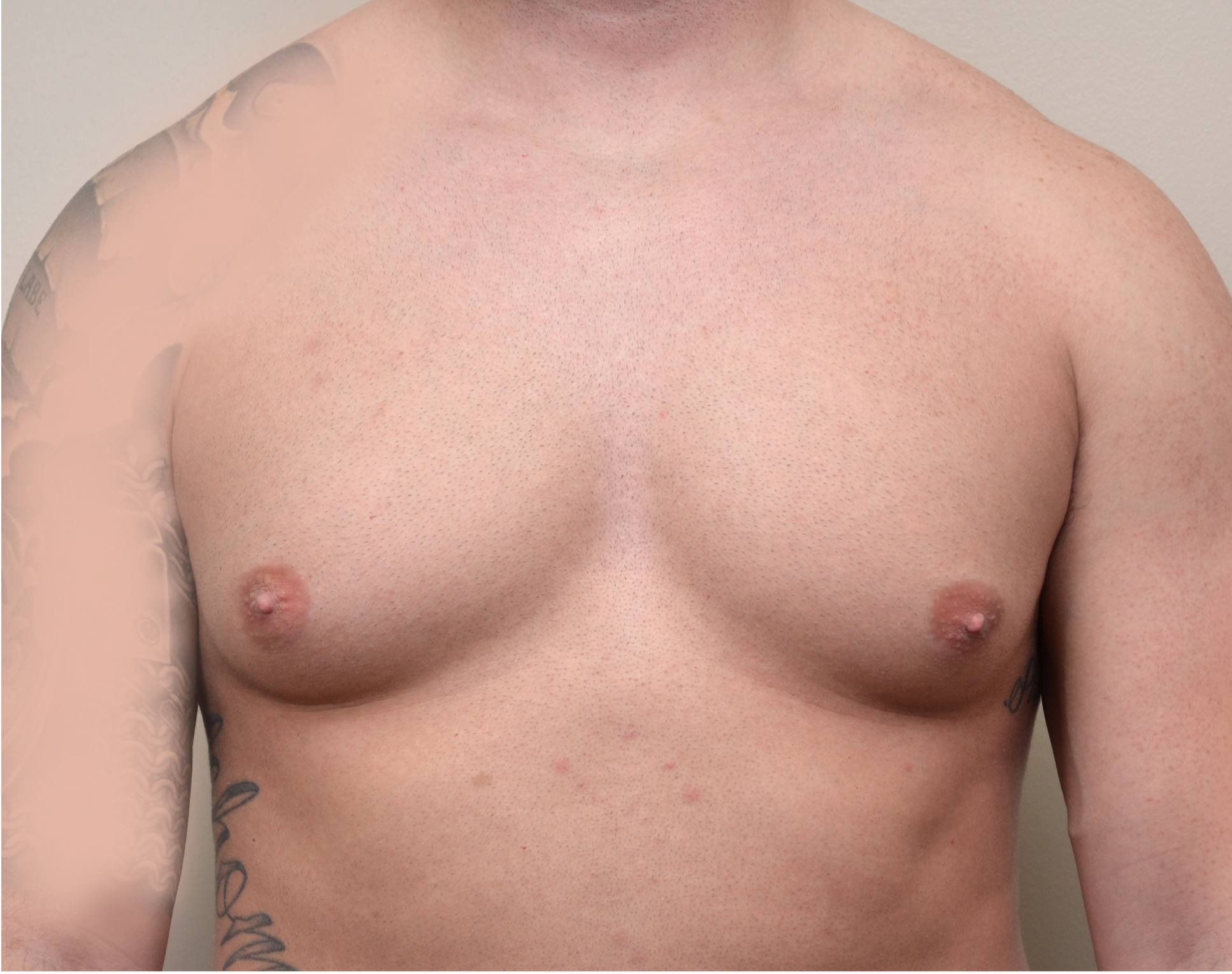 Gyno 79