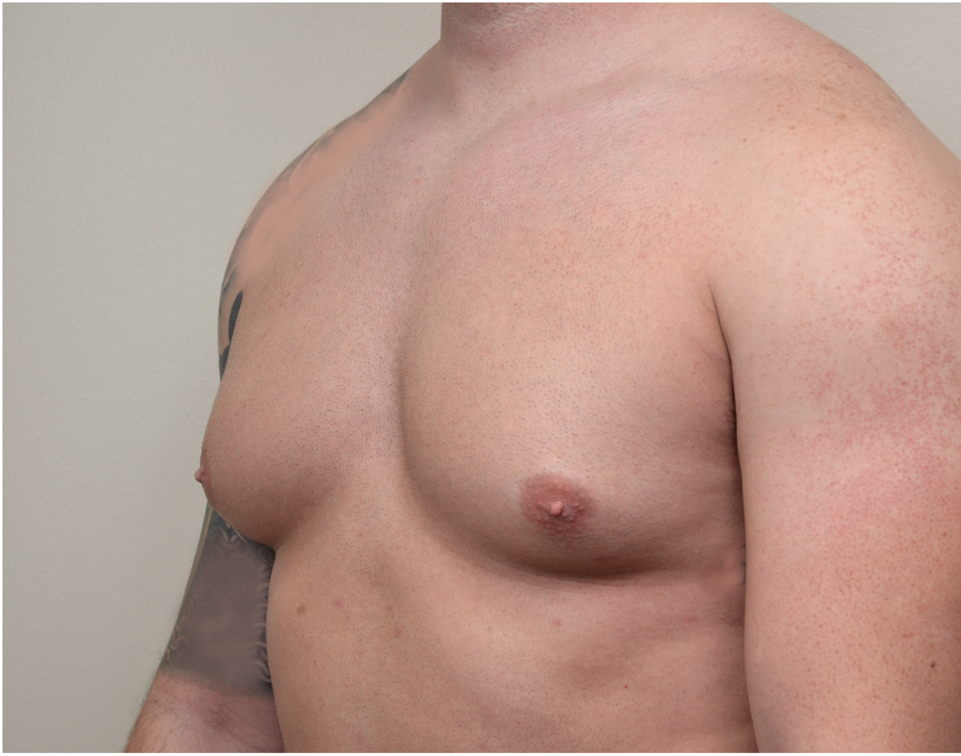 Gynecomastia Before & After Case 11