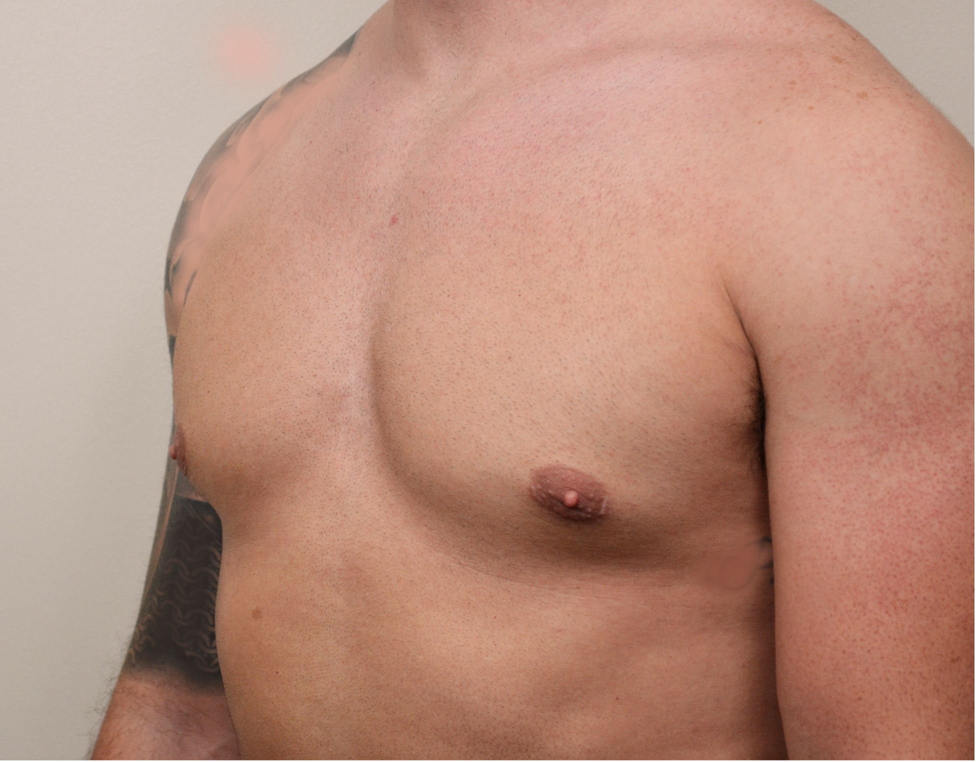 Gynecomastia Before & After Case 11