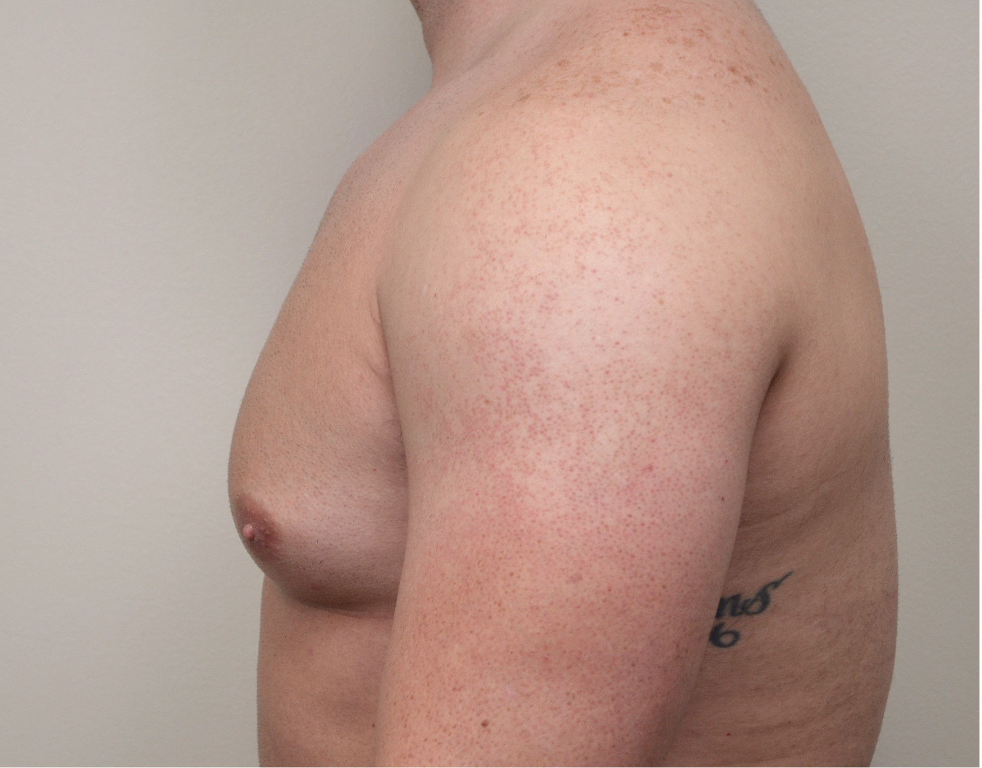 Gynecomastia Before & After Case 11