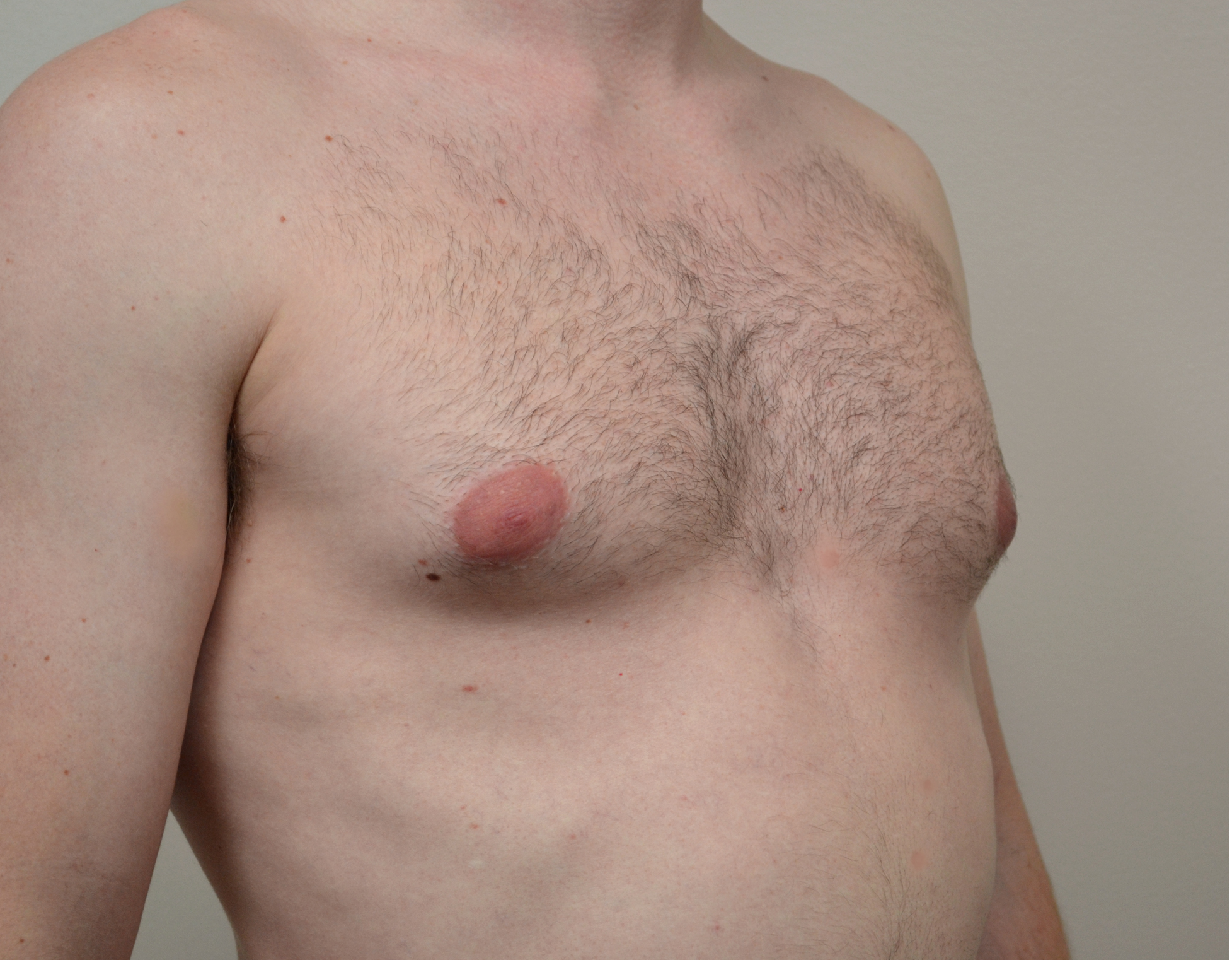 Gynecomastia Before & After Case 2