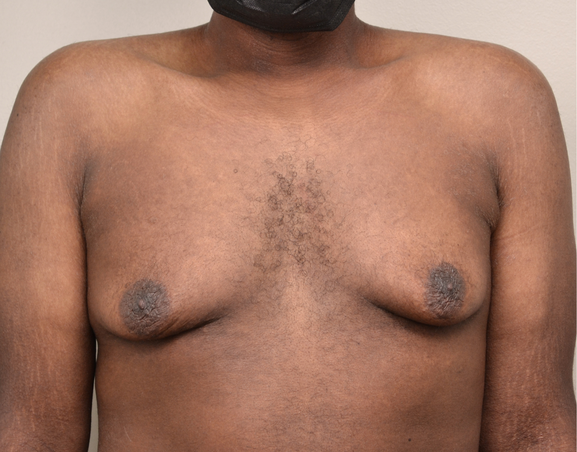 Gyno w_ng 1
