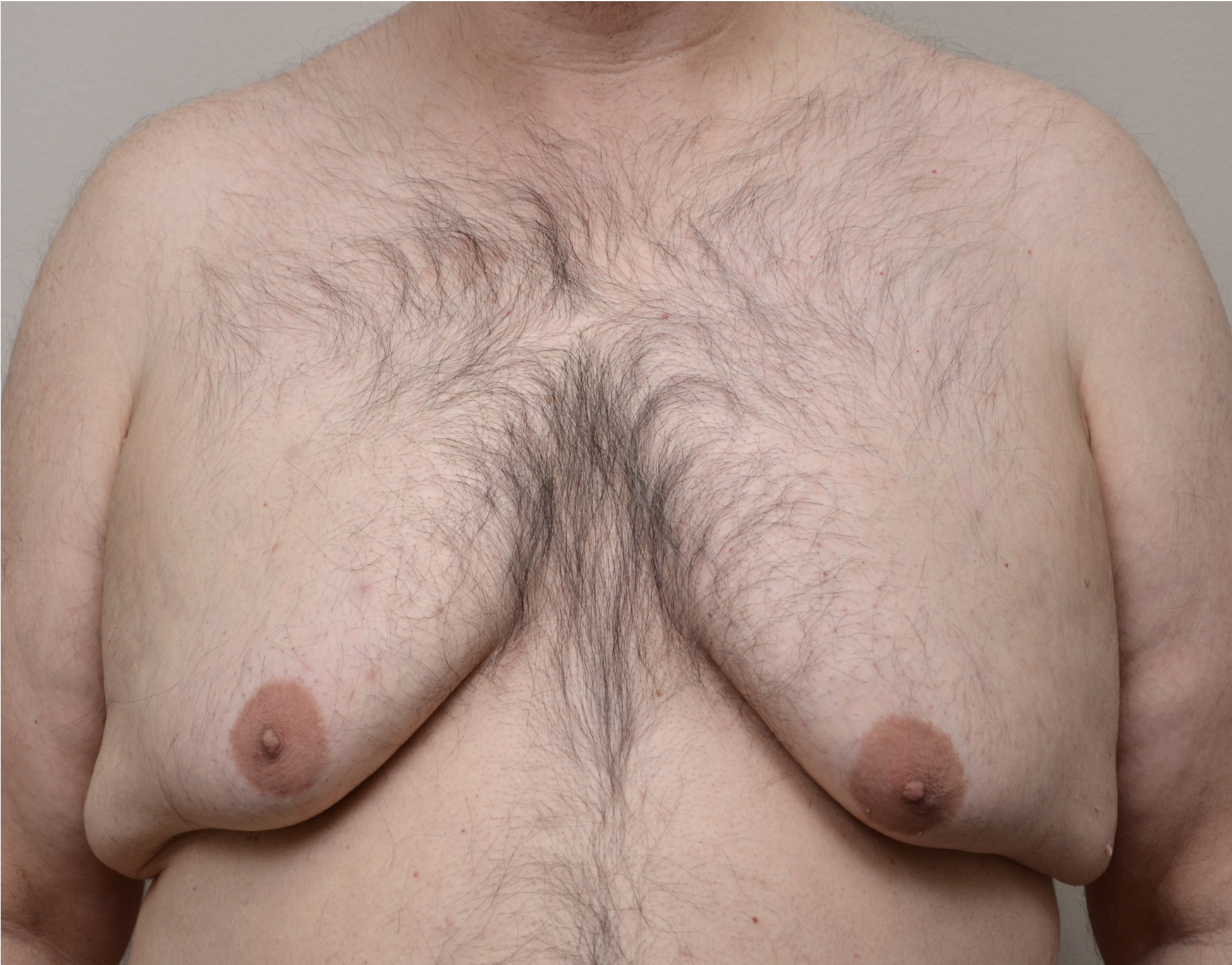 Gyno w_ng 13