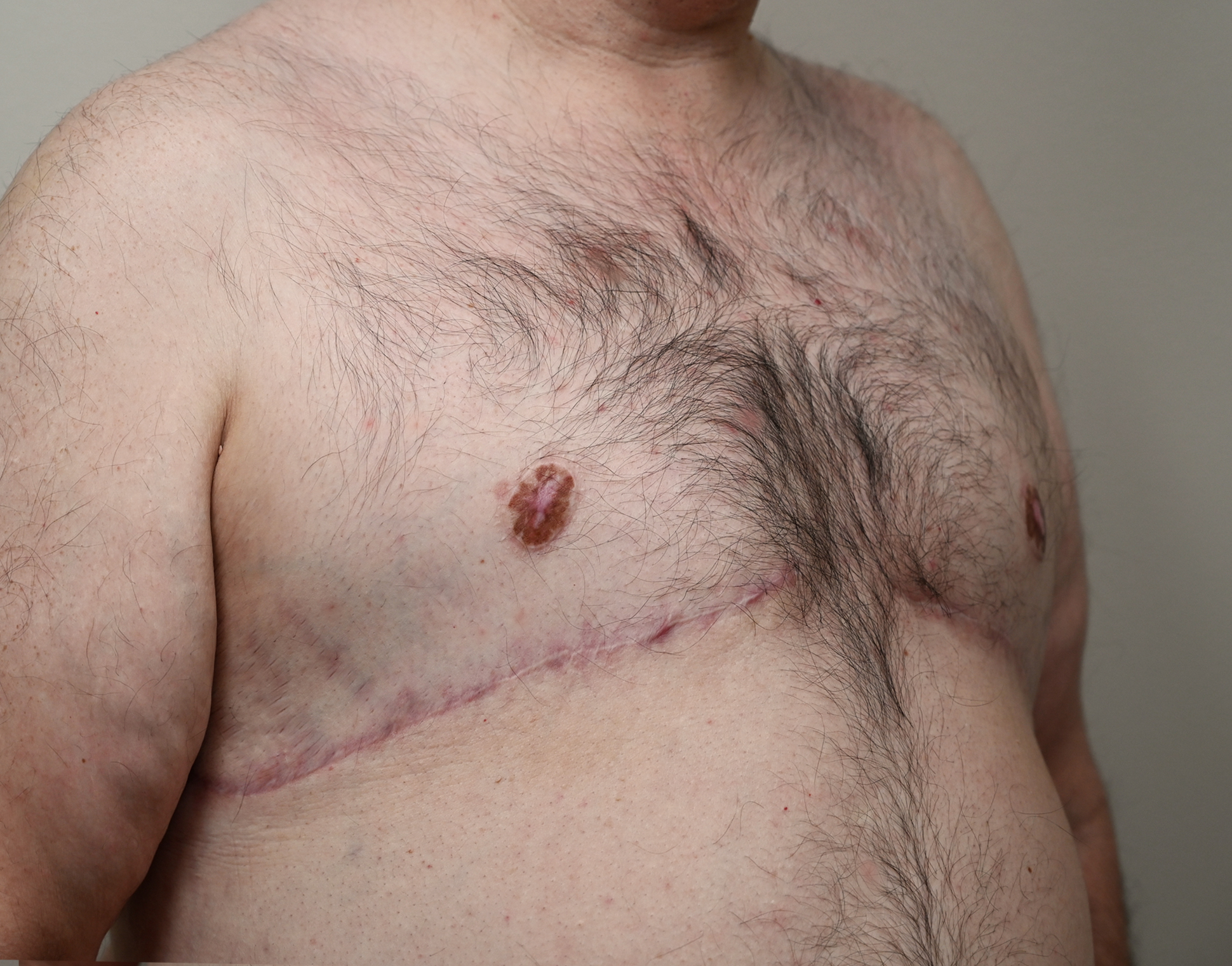 Gynecomastia Before & After Case 14