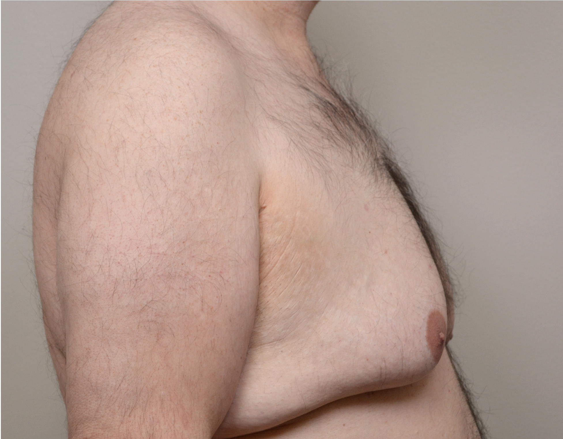 Gynecomastia Before & After Case 14