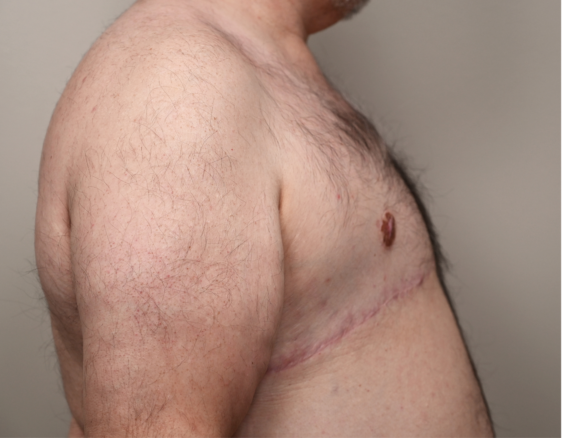 Gynecomastia Before & After Case 14