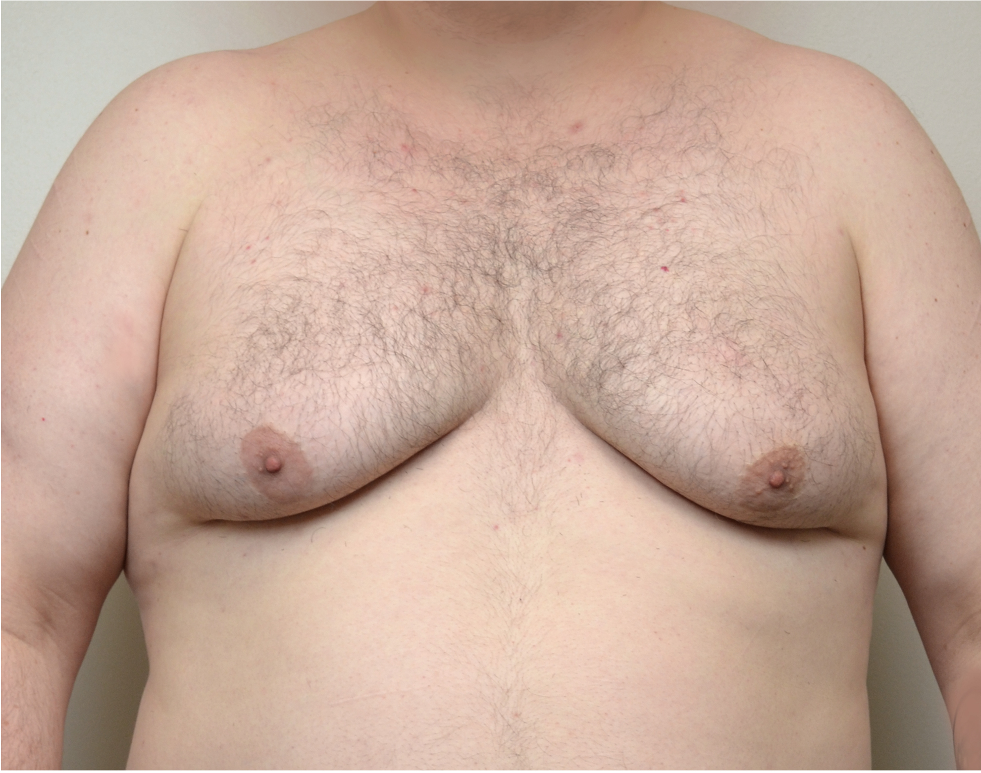 Gyno w_ng 19