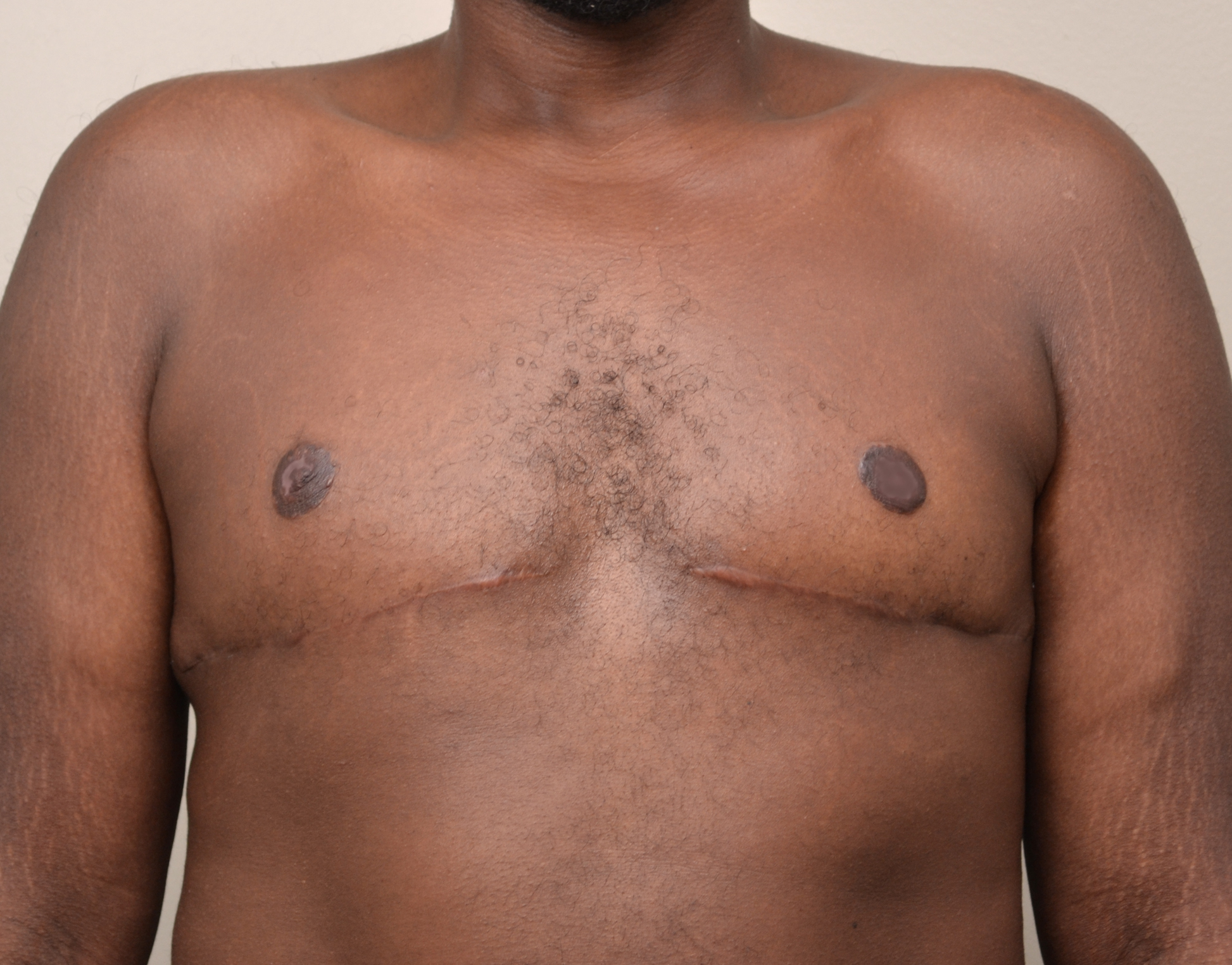 Gynecomastia Before & After Case 12