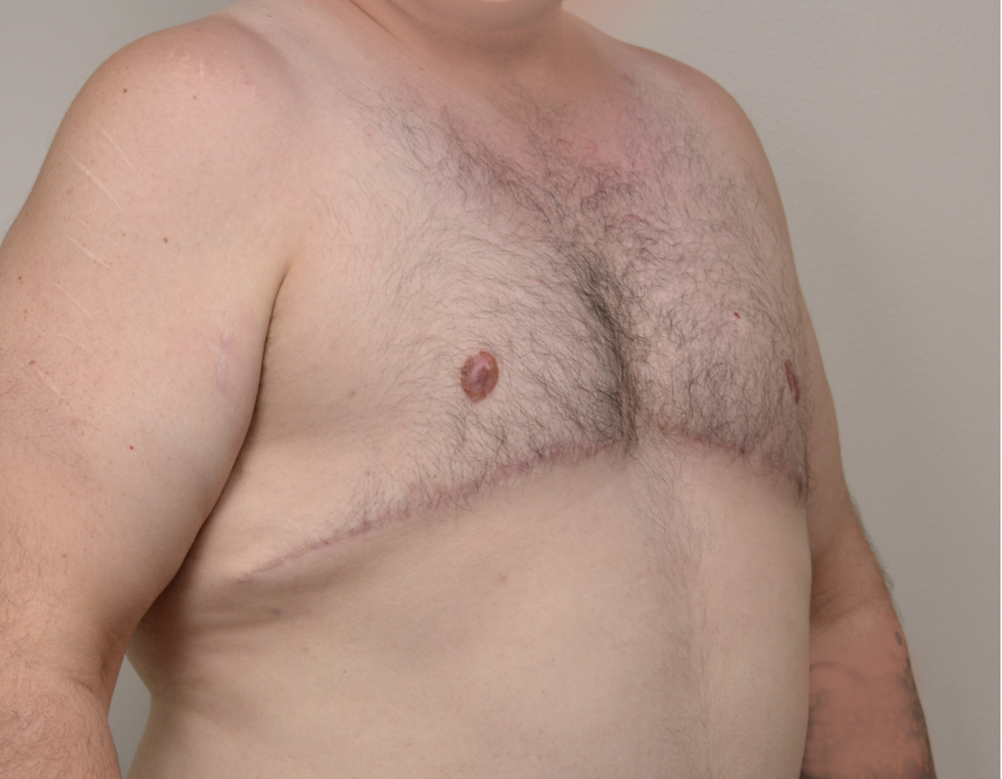 Gynecomastia Before & After Case 15