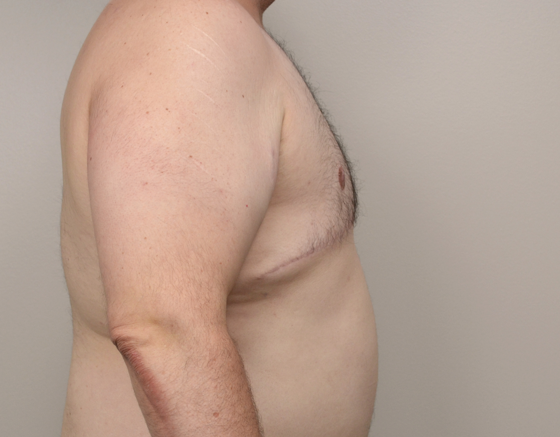 Gynecomastia Before & After Case 15