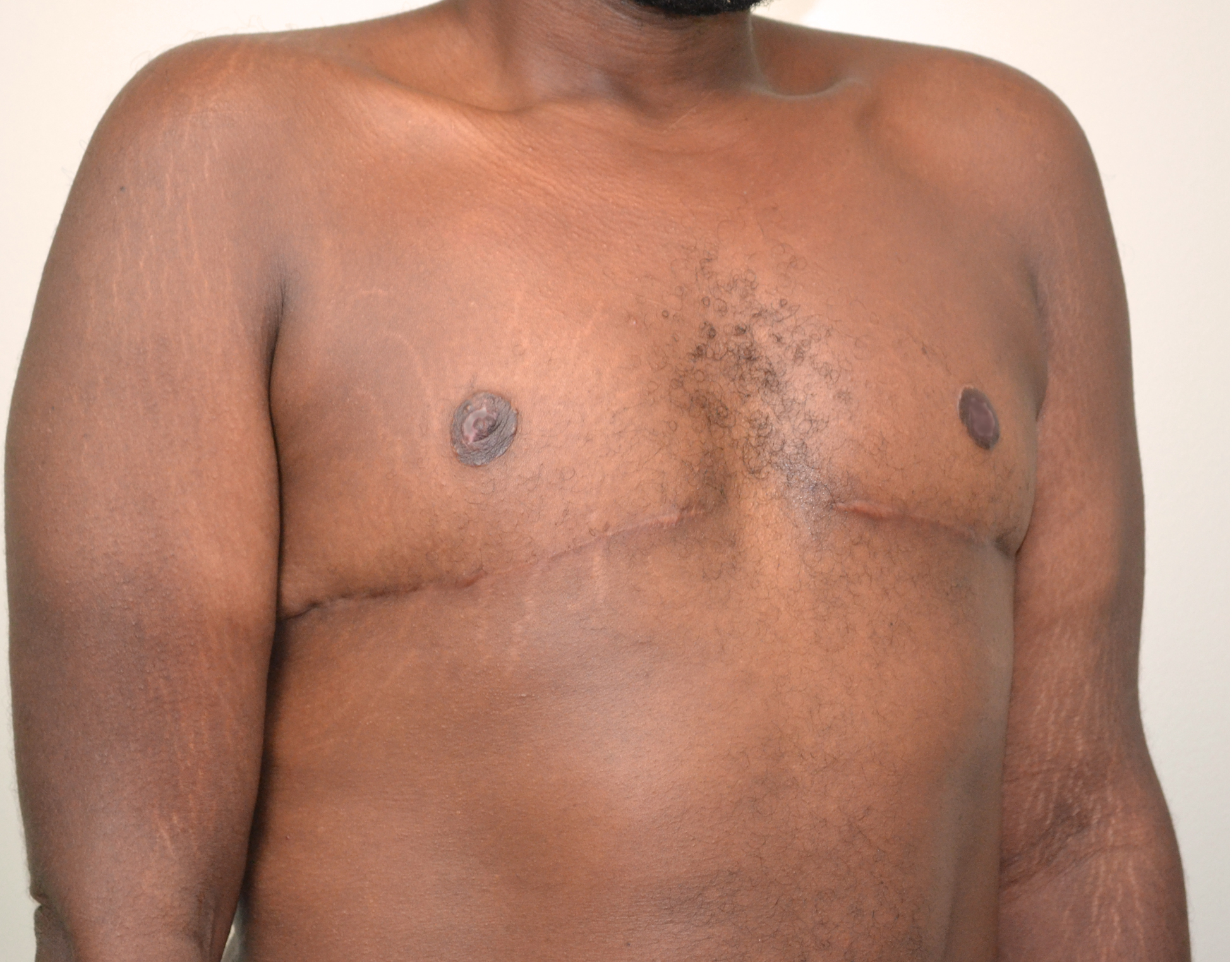 Gynecomastia Before & After Case 12