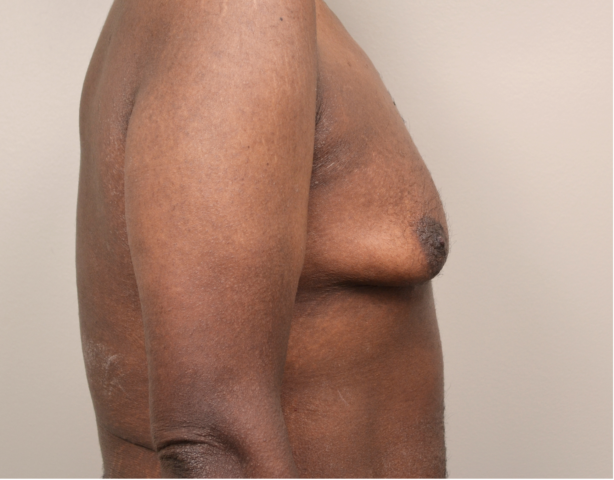 Gynecomastia Before & After Case 12
