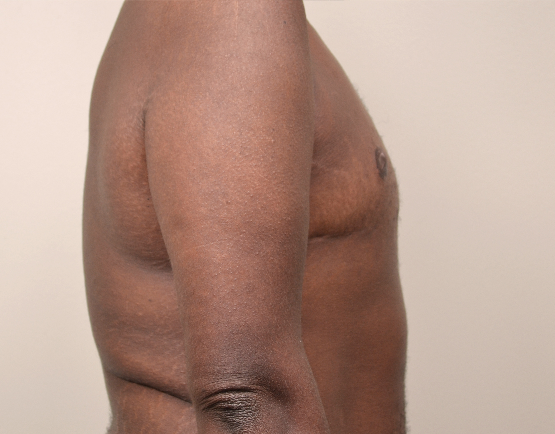 Gynecomastia Before & After Case 12
