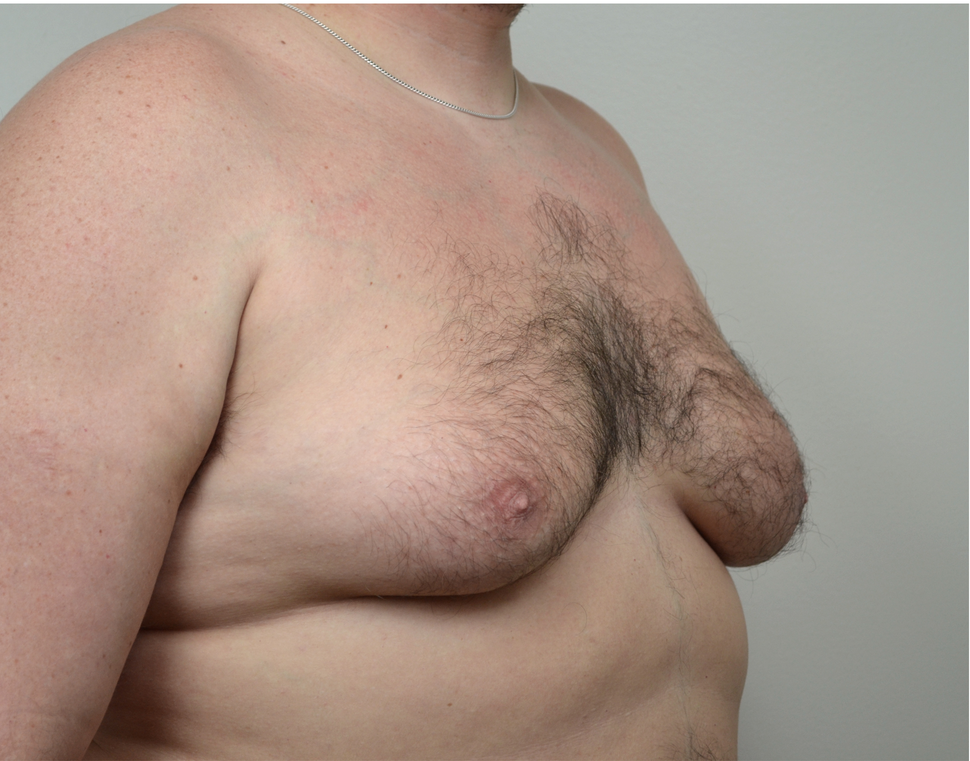 Gynecomastia Before & After Case 13