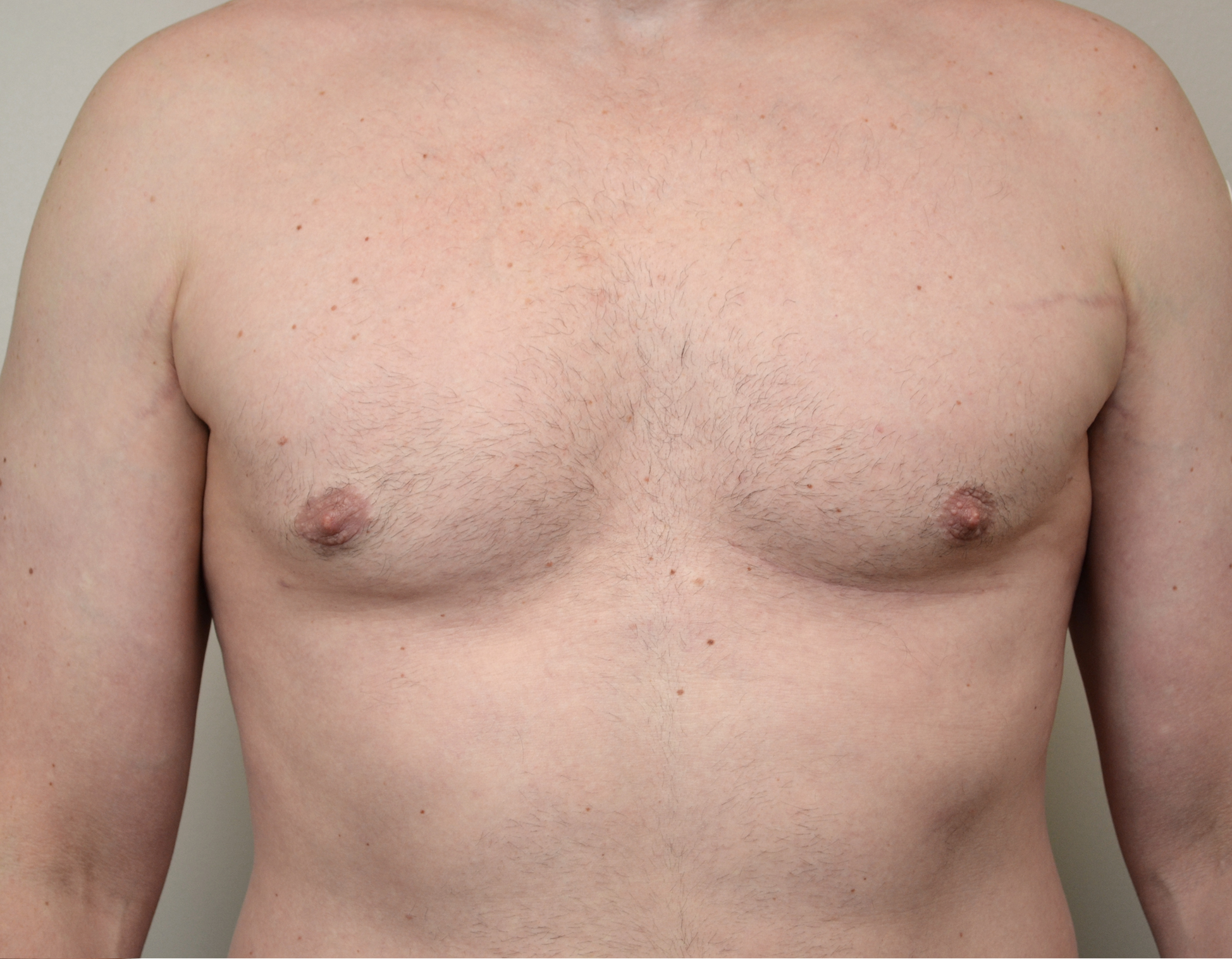 Gynecomastia Before & After Case 16