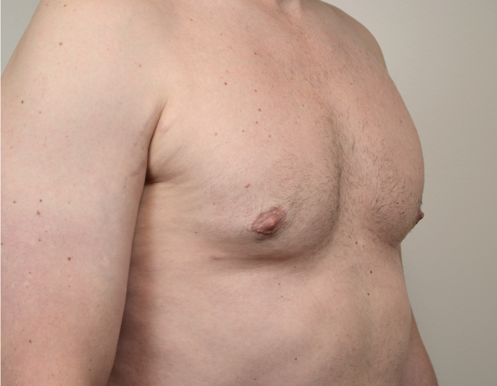 Gynecomastia Before & After Case 16
