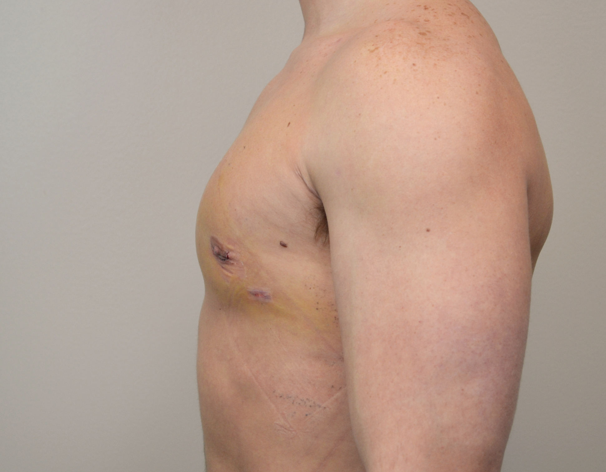Gynecomastia Before & After Case 17