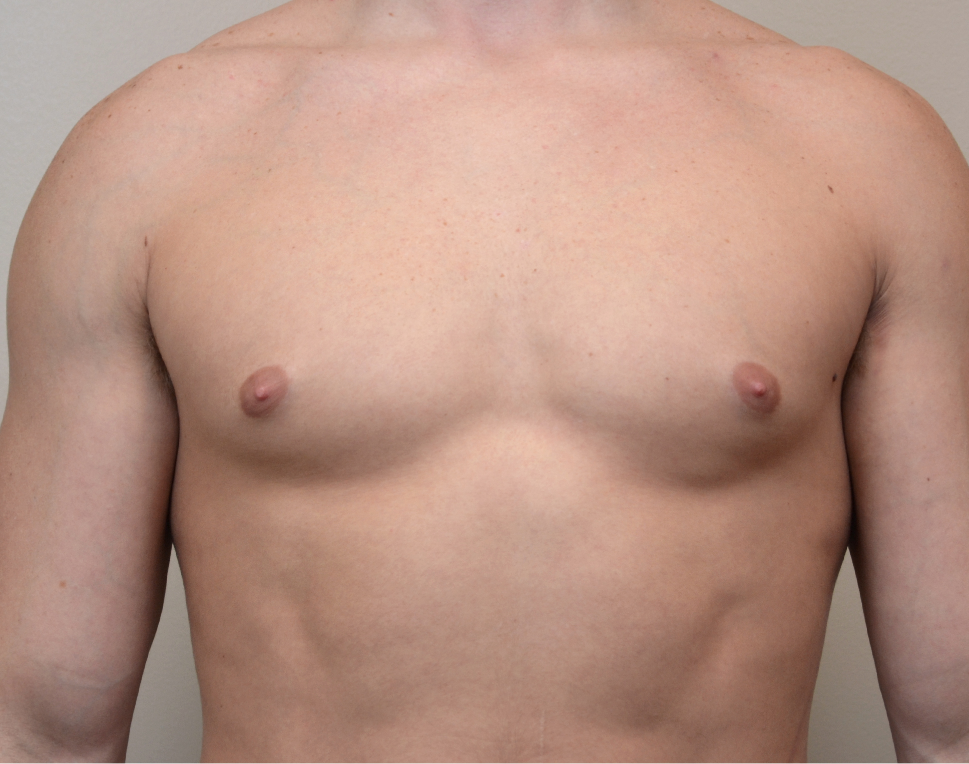 17 Gyno b1