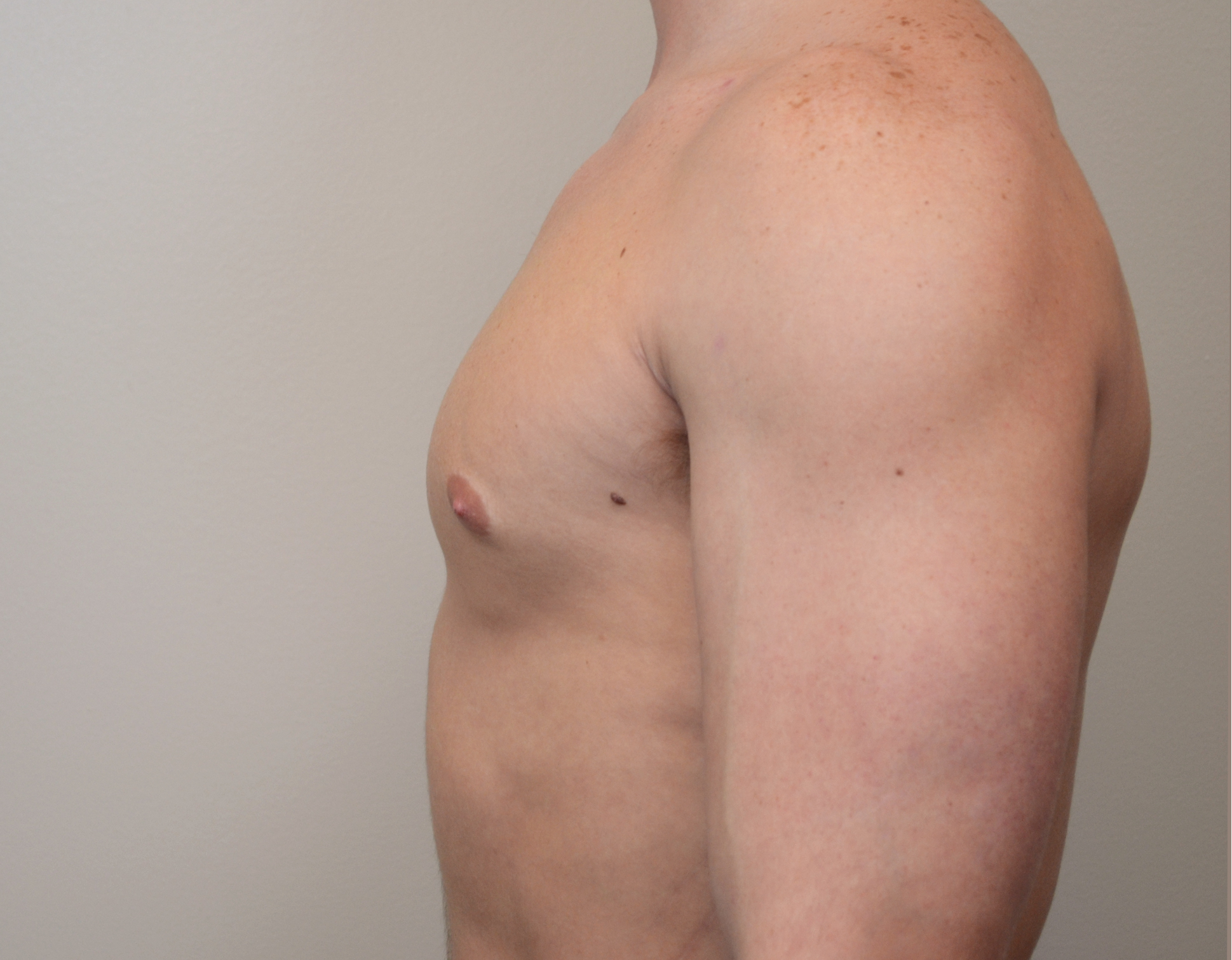 Gynecomastia Before & After Case 17