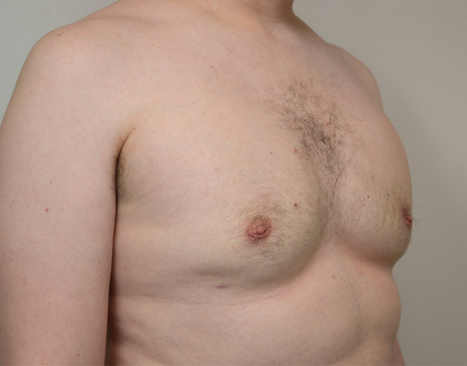 Gynecomastia Before & After Case 18