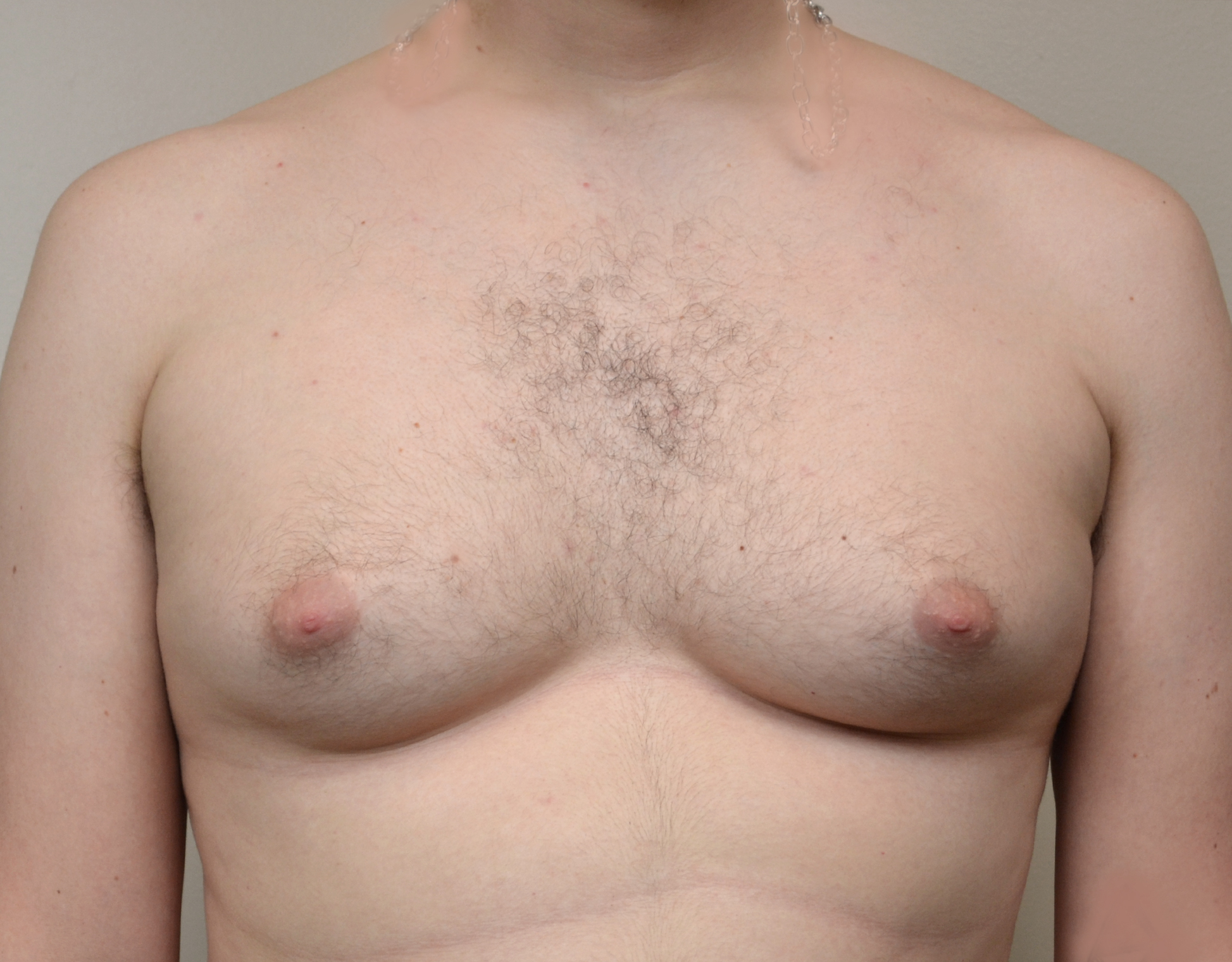 18 Gyno b1