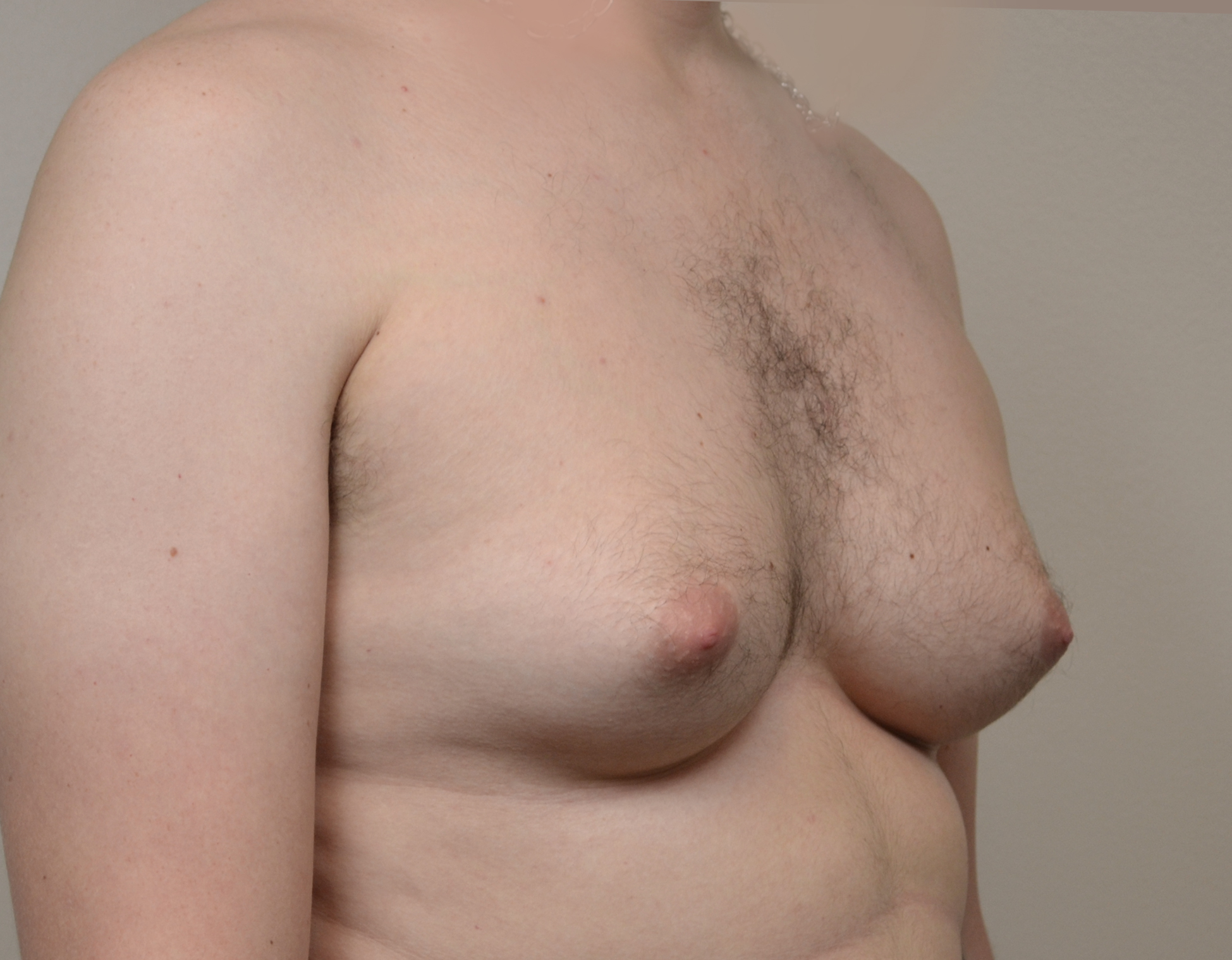 Gynecomastia Before & After Case 18