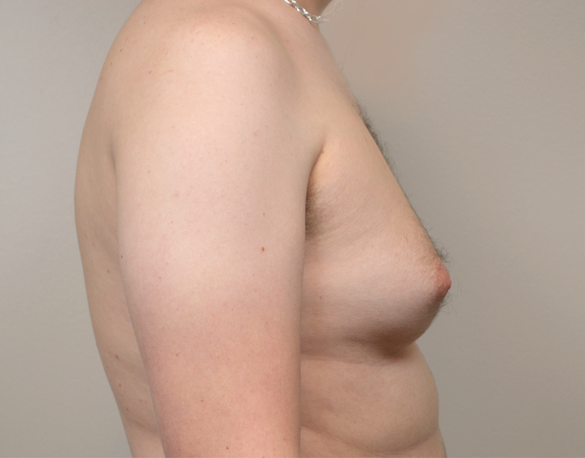 Gynecomastia Before & After Case 18