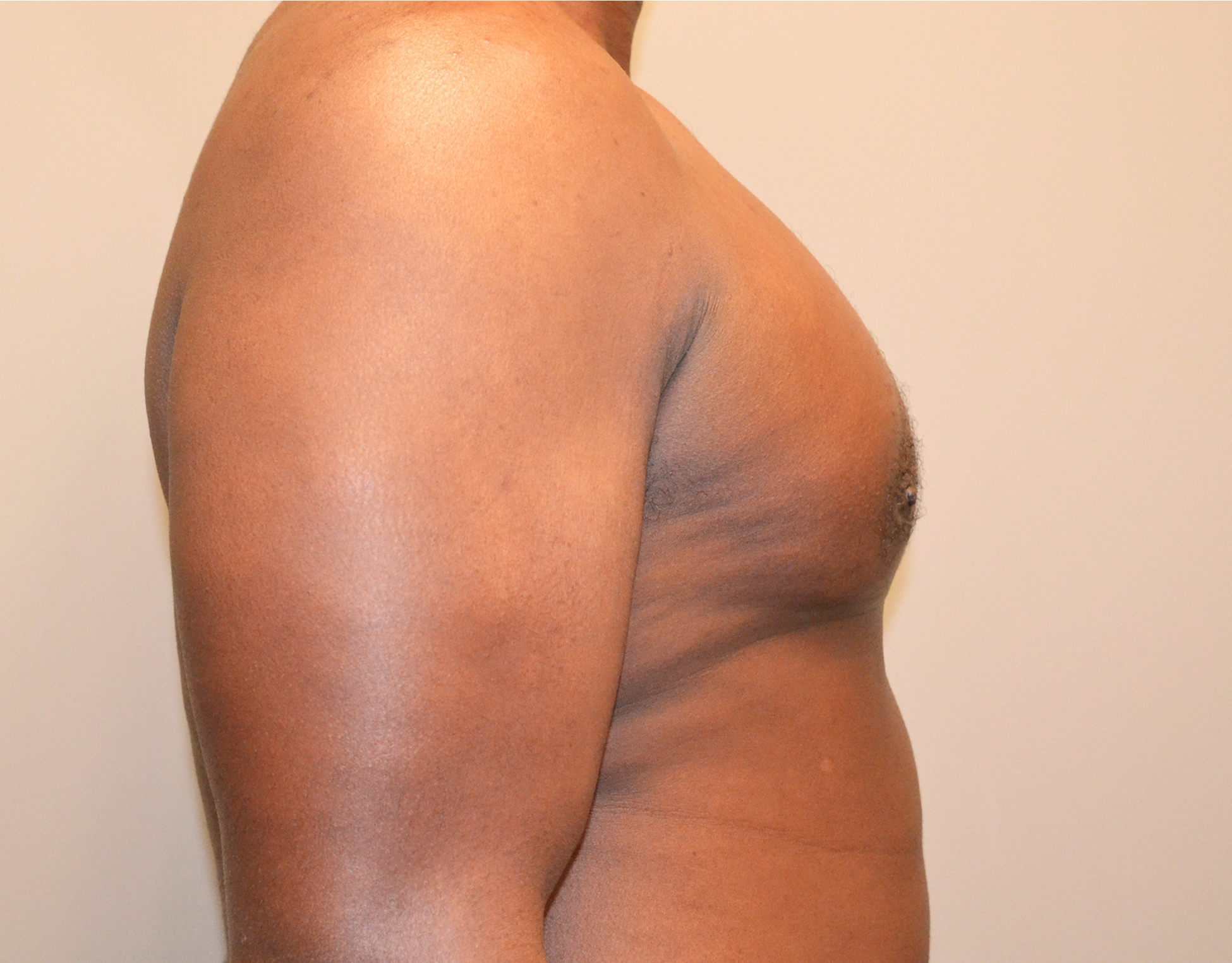Gynecomastia Before & After Case 19